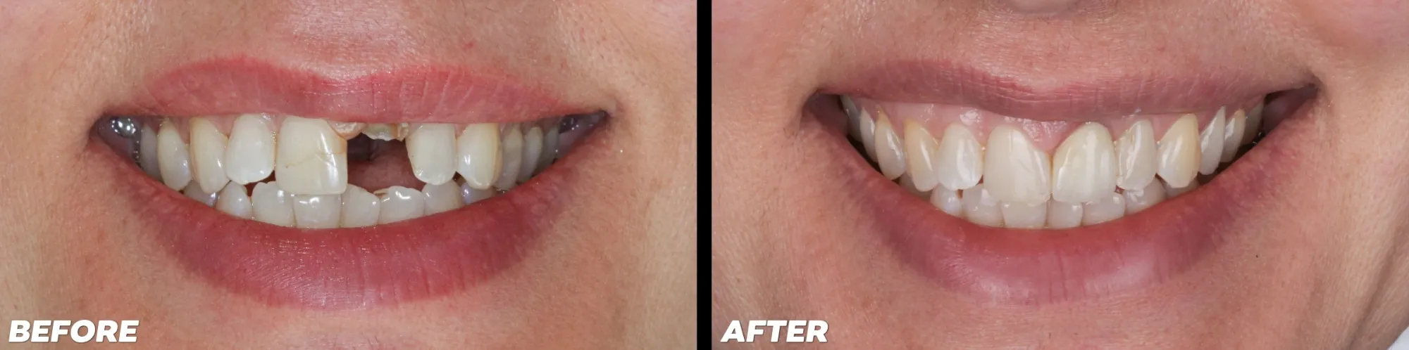 Dental Implants - Before and After