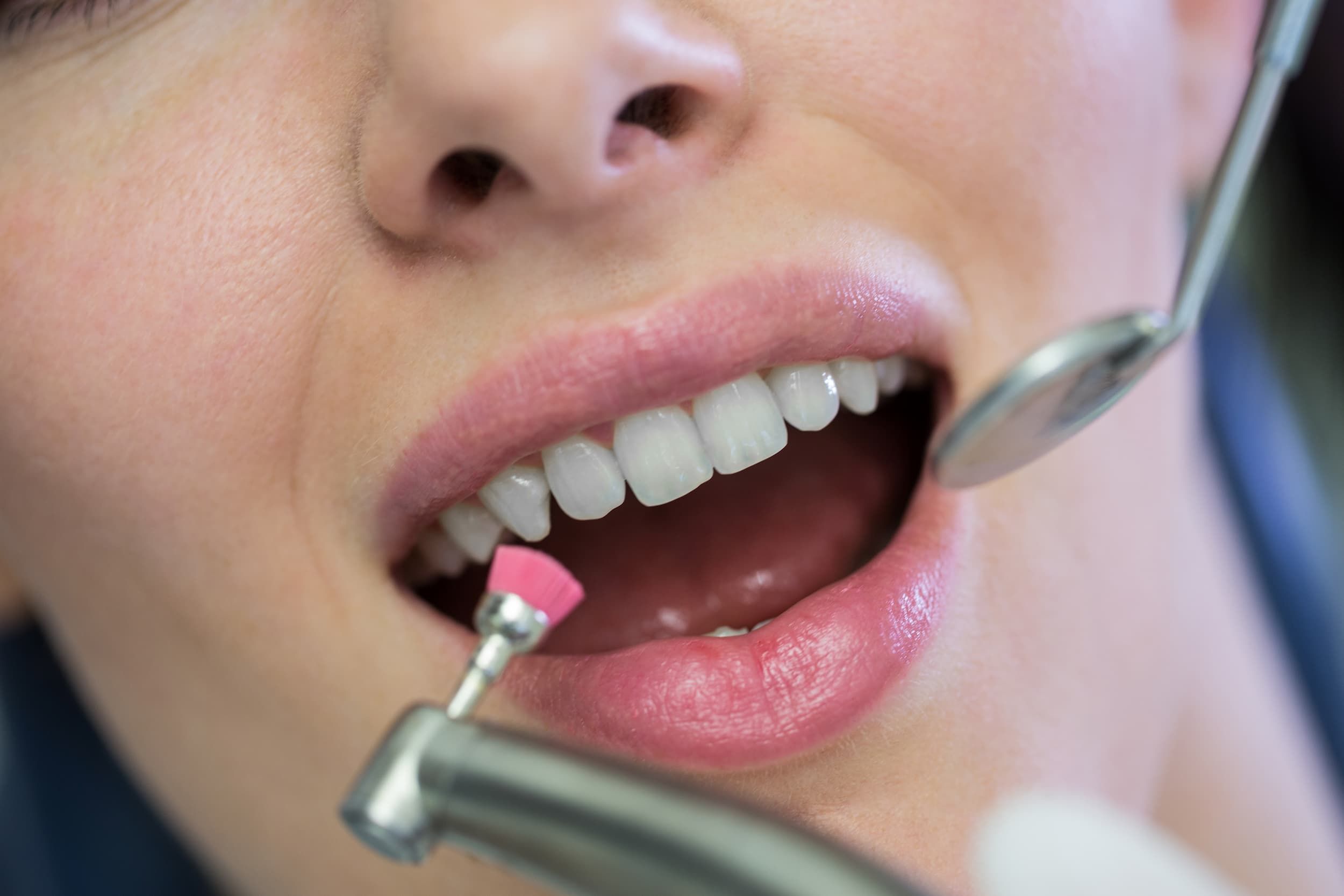 Enameloplasty tooth reshaping treatment at Enclave Dental in Lake Mary, FL