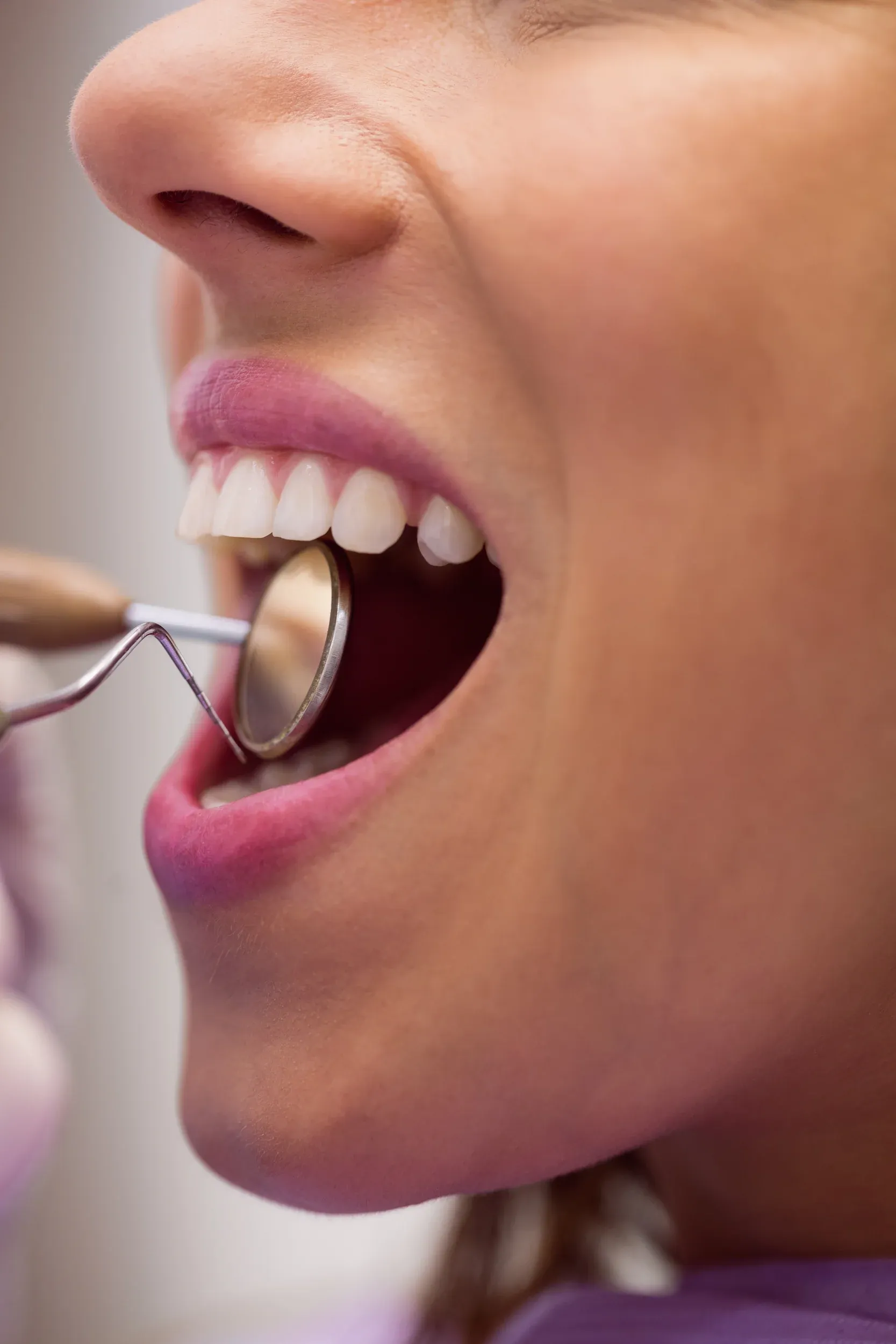 Diamond bur dental instrument used for enameloplasty at Enclave Dental Lake Mary FL
