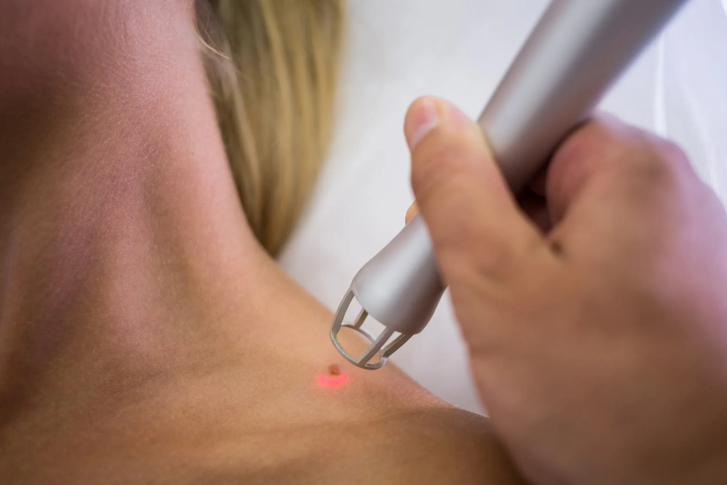 minor surgical procedures in-office Paradise Family Healthcare Venice FL