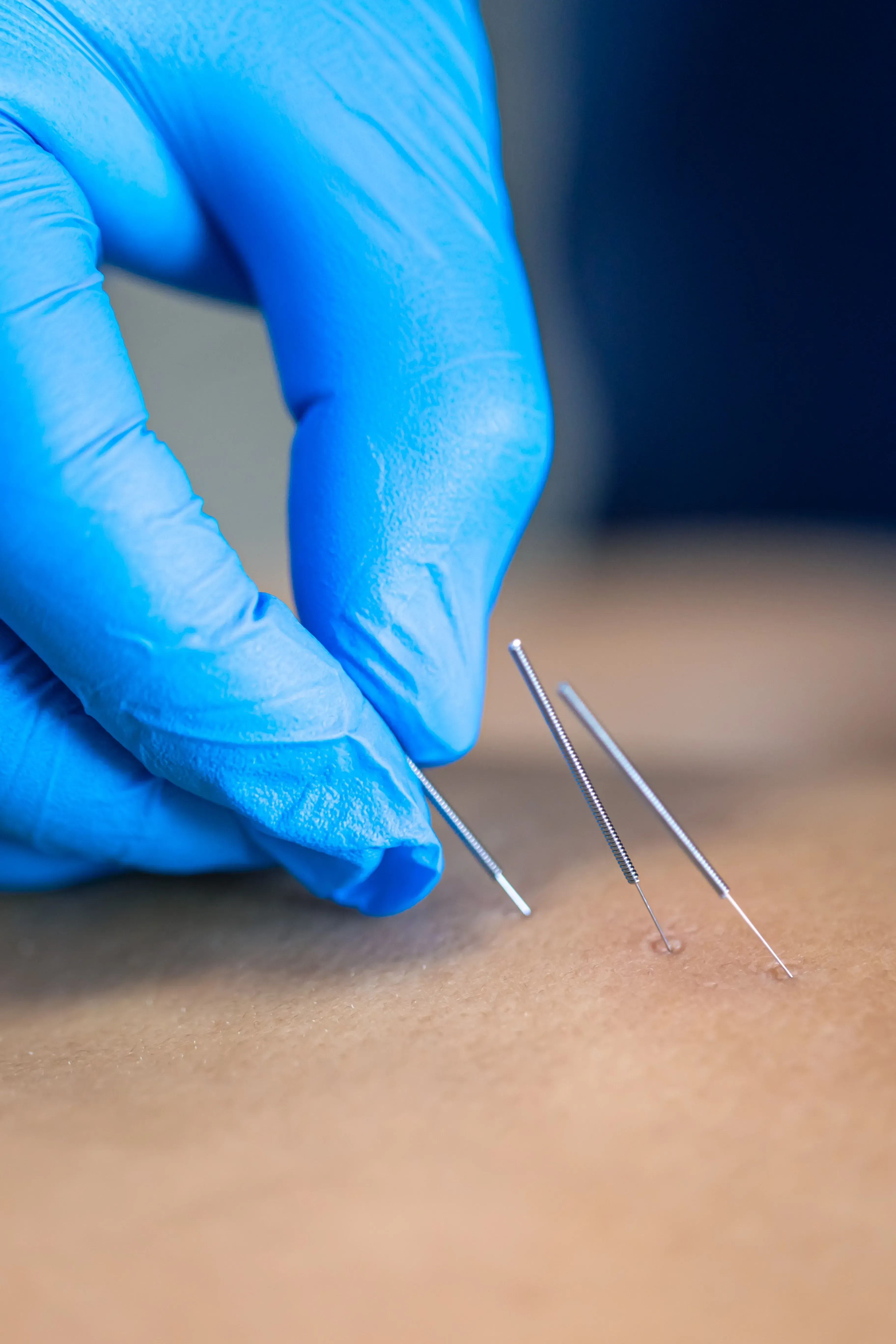 Before and after dry needling results at Spine-Ability Apollo Beach FL