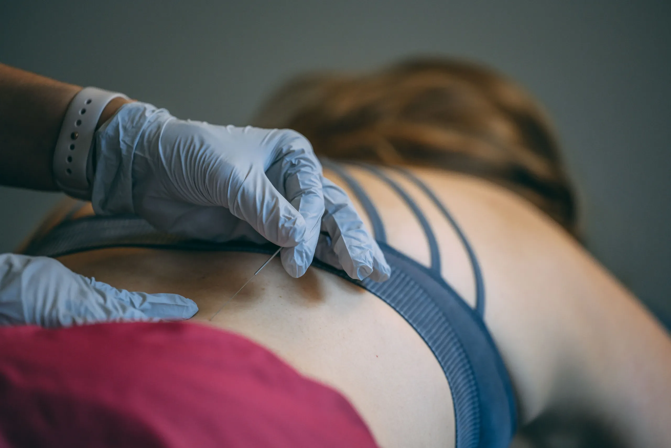 Dry needling therapy for trigger point pain relief in Alma, GA