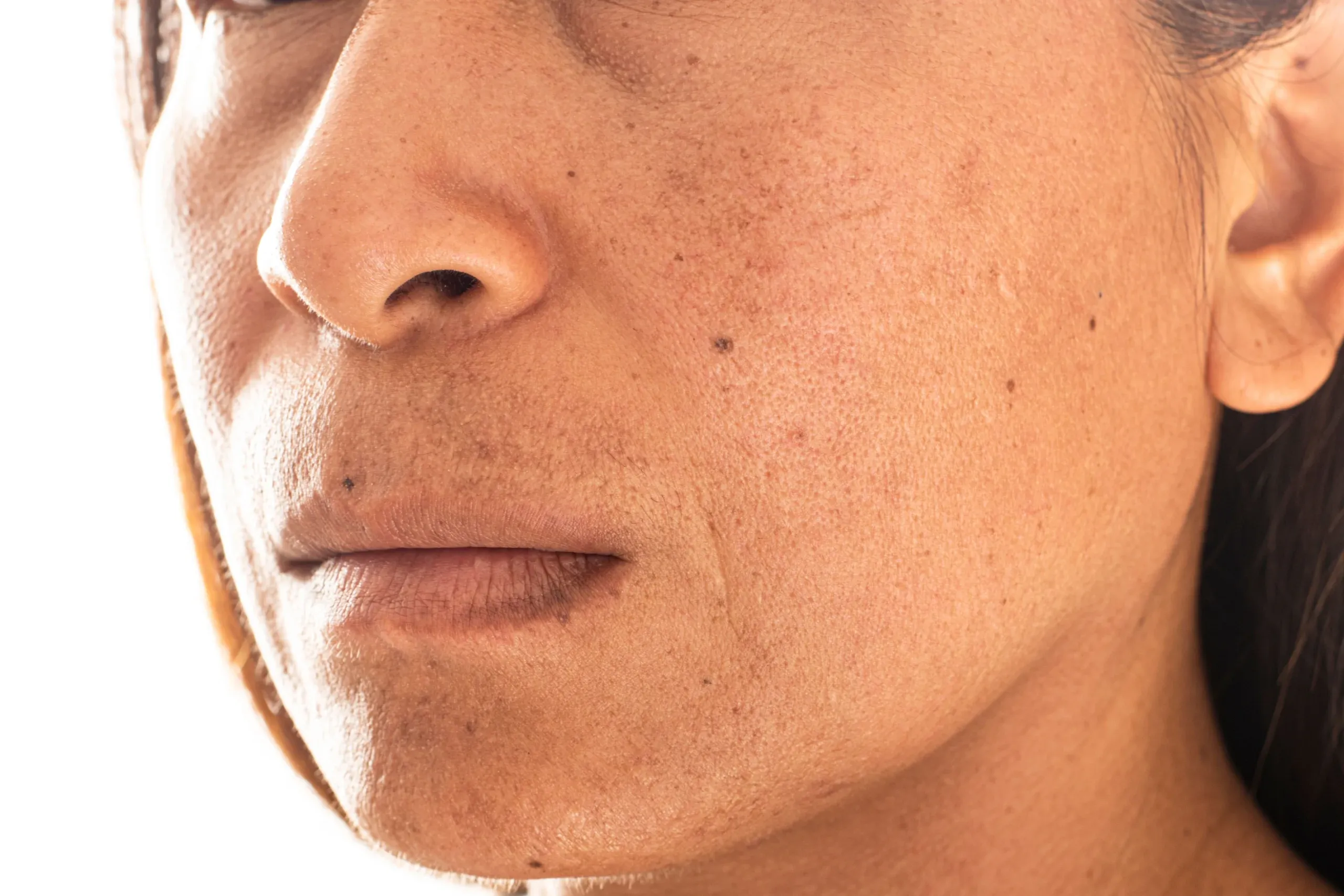 Close-up showing dull uneven skin texture at Eternal Wellness Medical Spa Traverse City