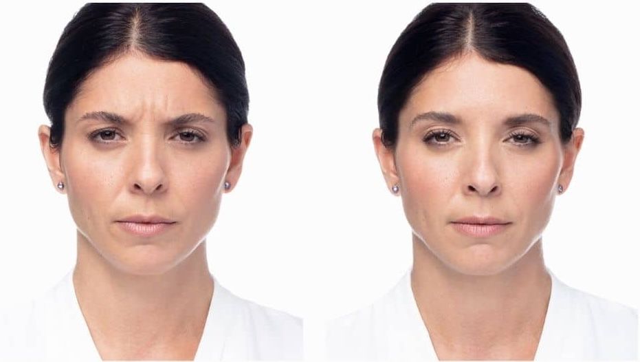 Dysport effect on frown lines