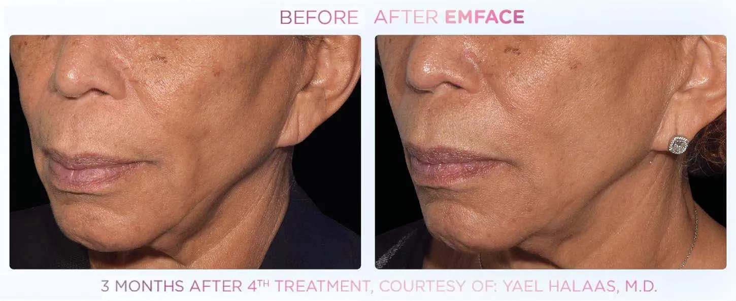 Emface effect on the cheeks