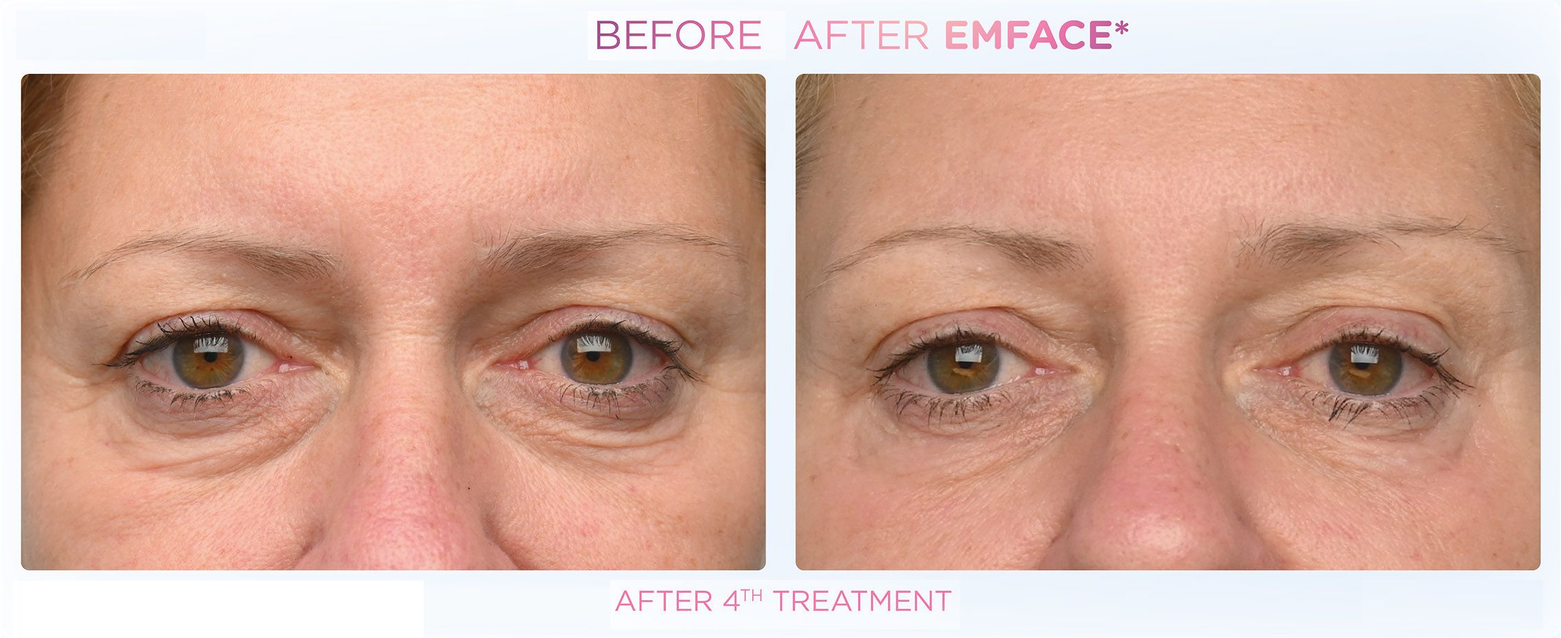 Emface - Before and After