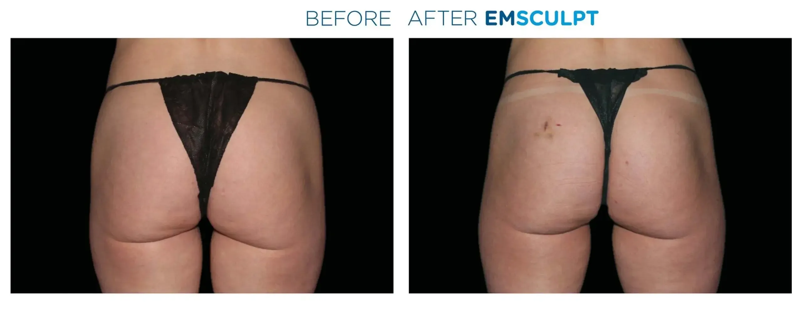 Emsculpt Neo before and after