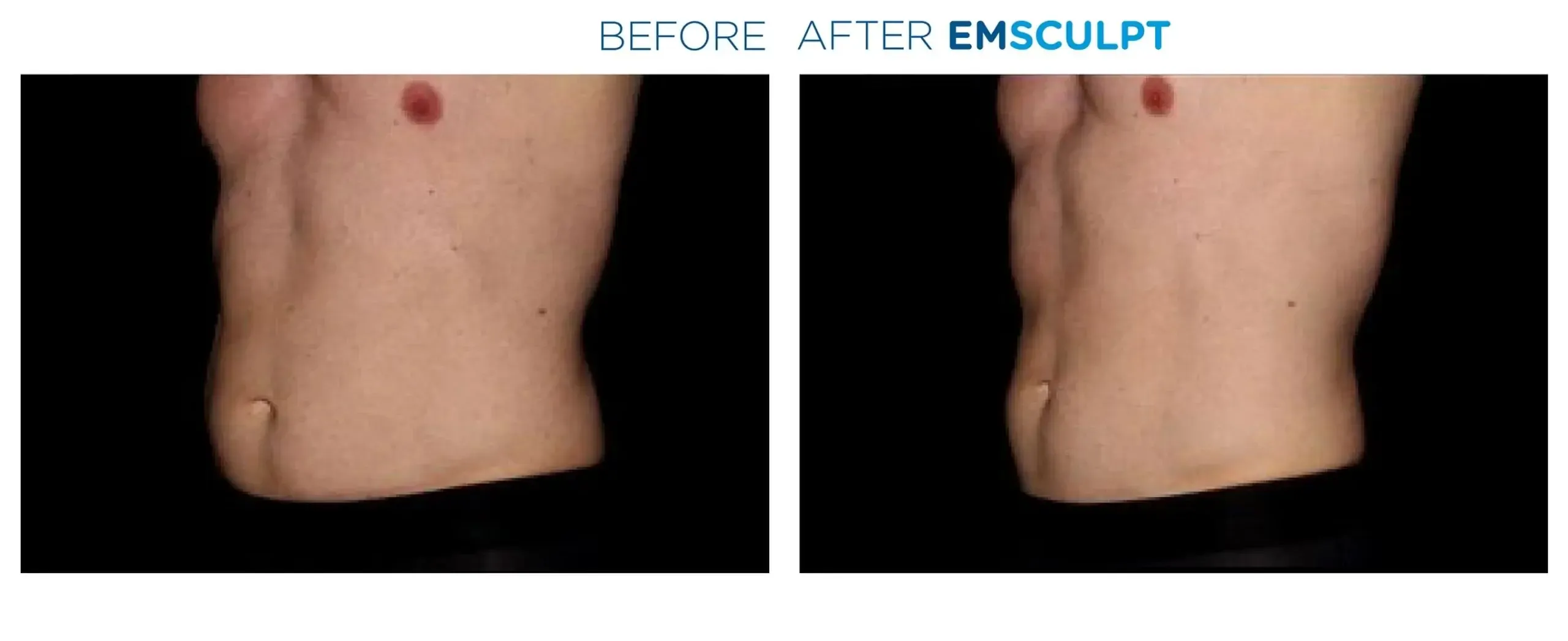 Emsculpt Neo before and after