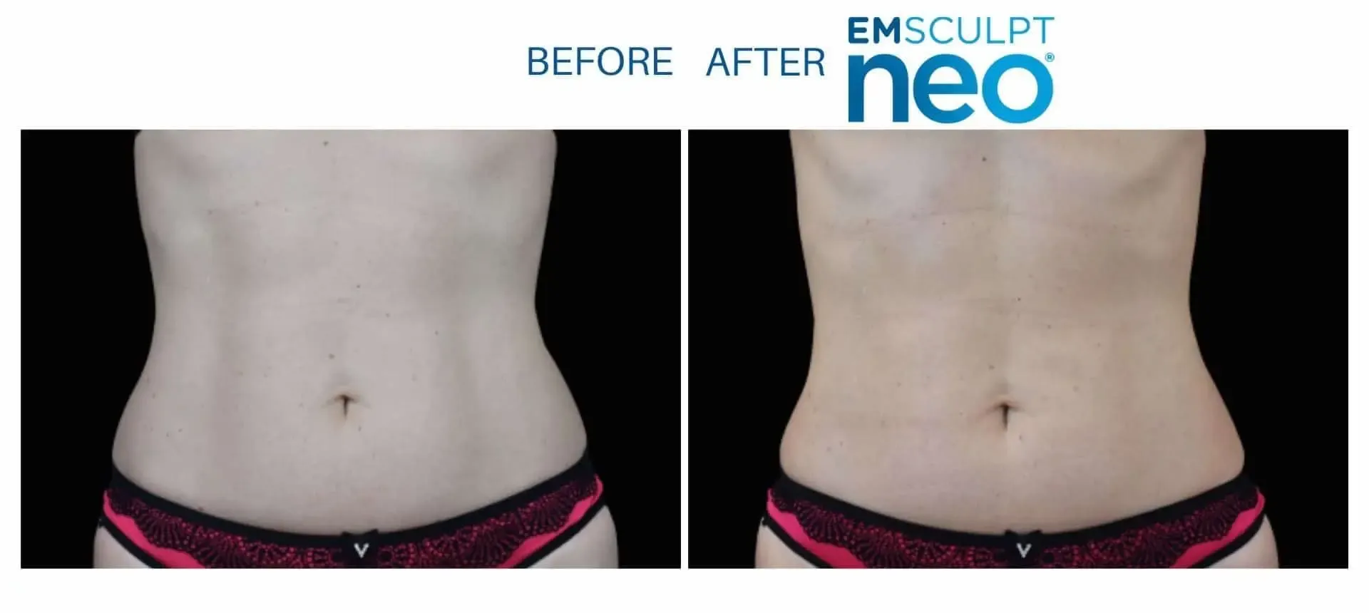 Emsculpt Neo before and after