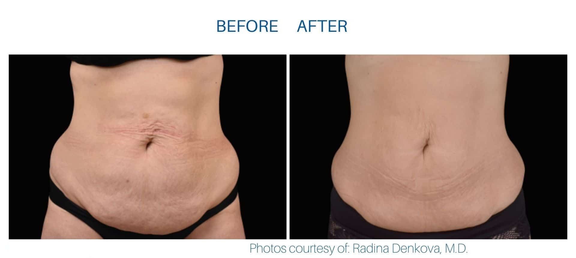 Emsculpt Neo effect on abdomen