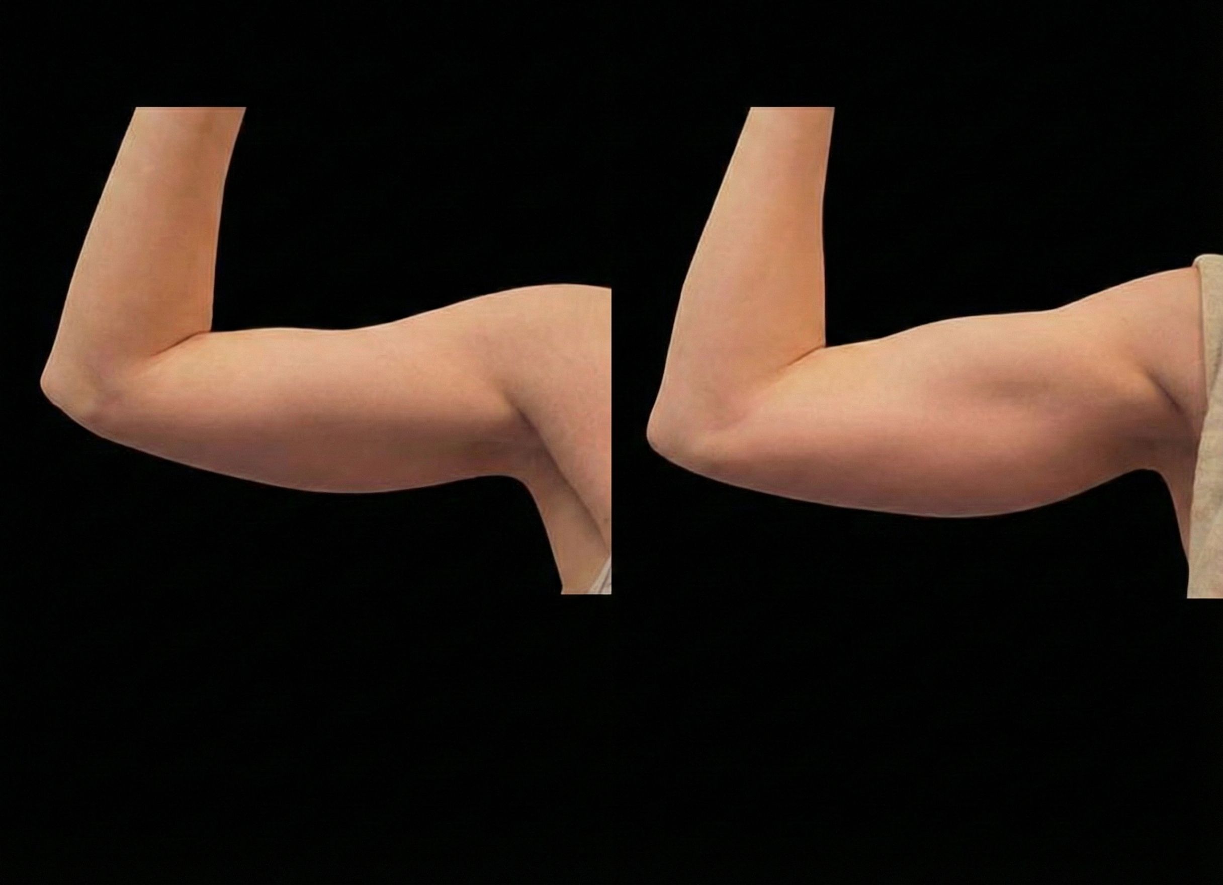 Emsculpt Neo before and after arm region