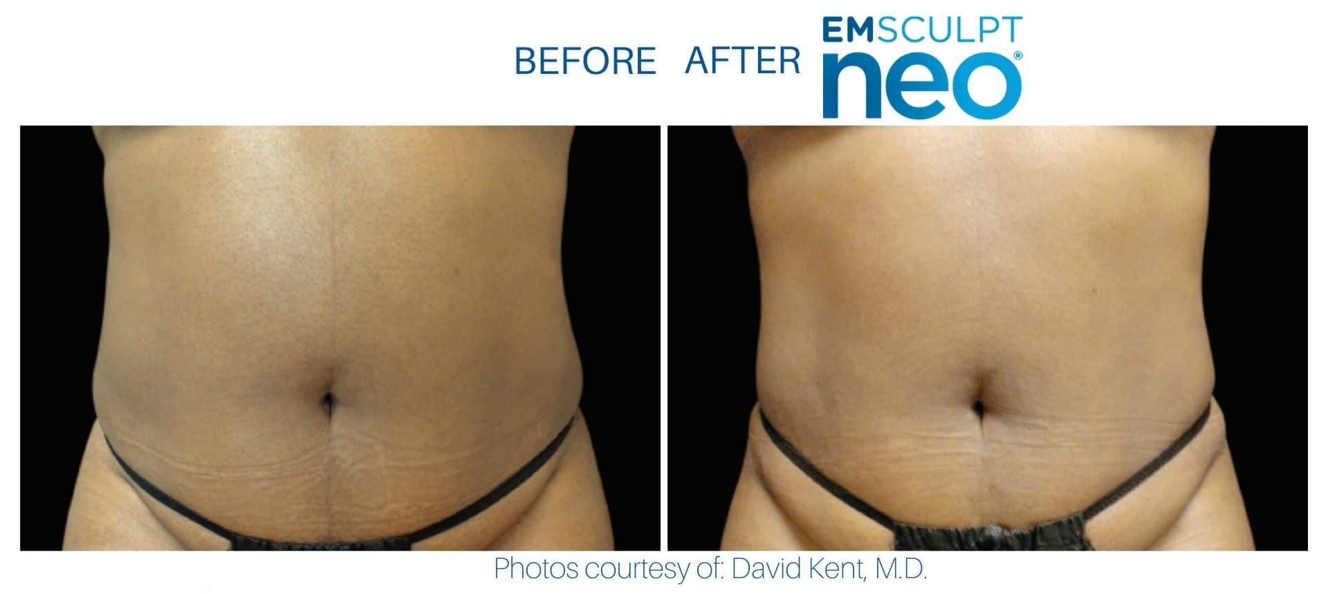 Emsculpt Neo effect on abdomen