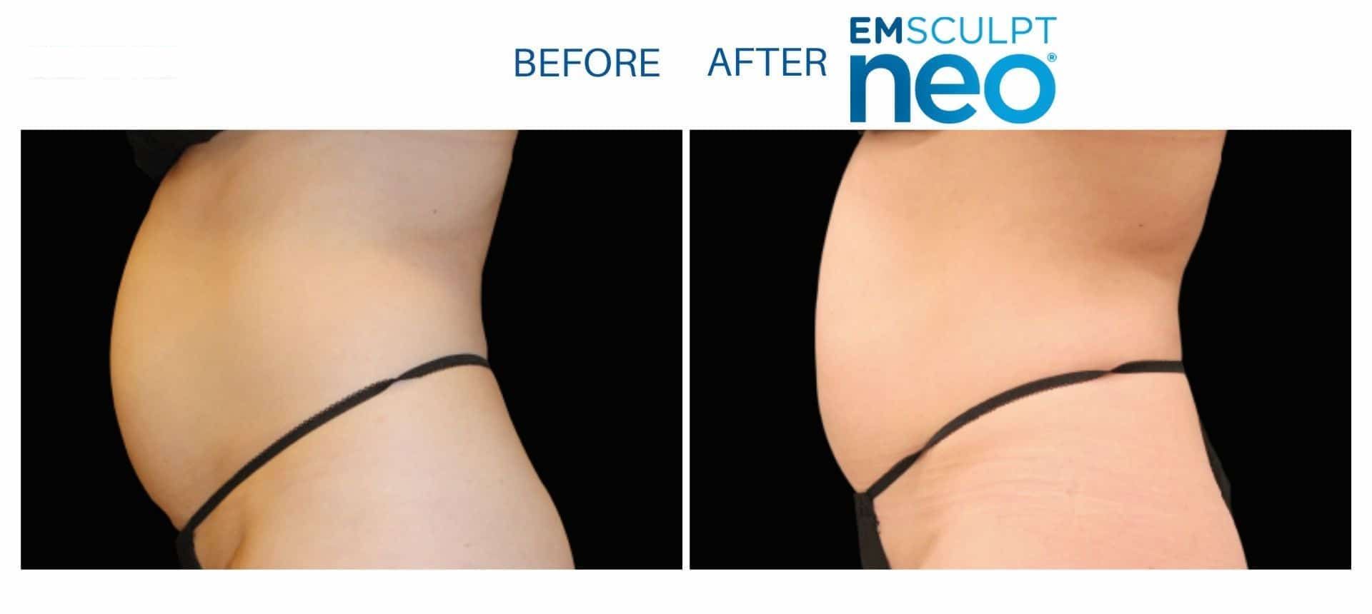 Emsculpt Neo - Before and After
