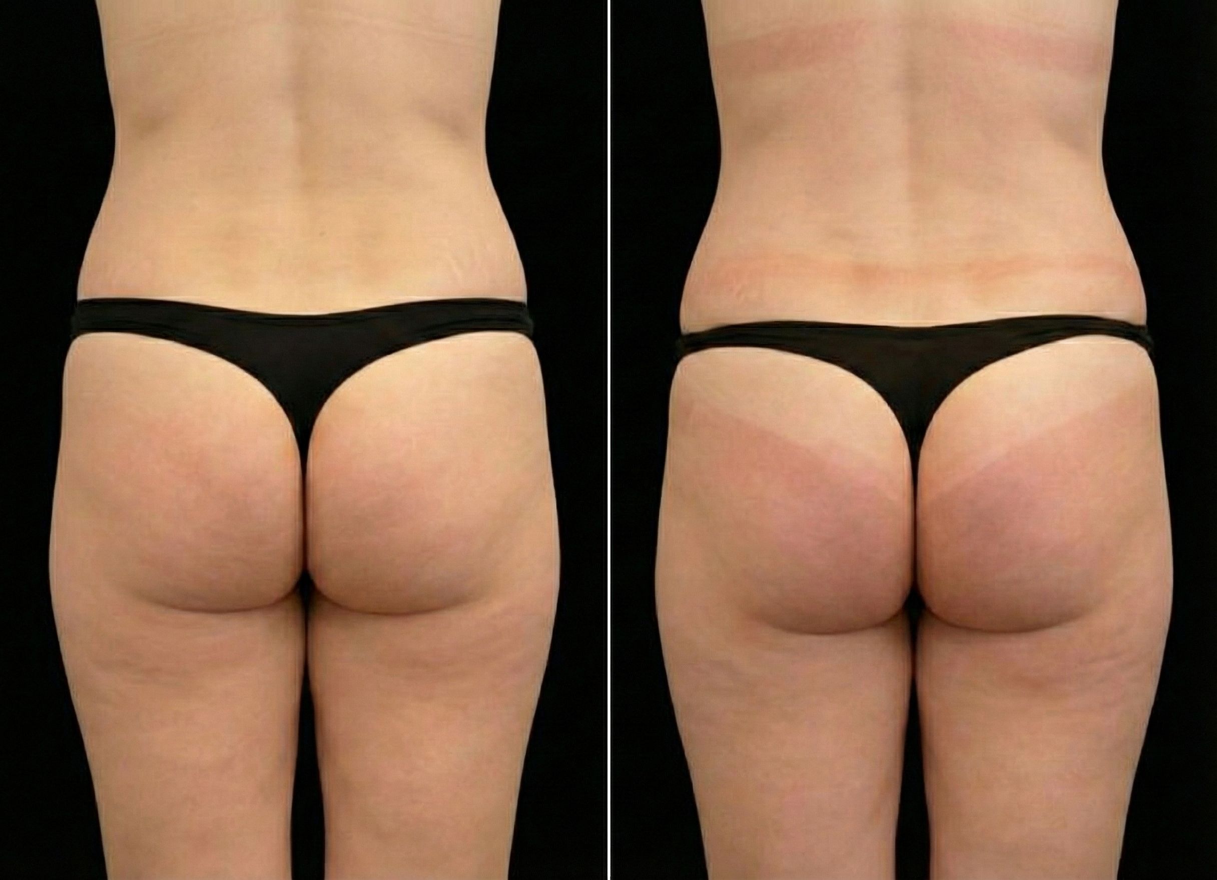 Emsculpt Neo effect on buttocks