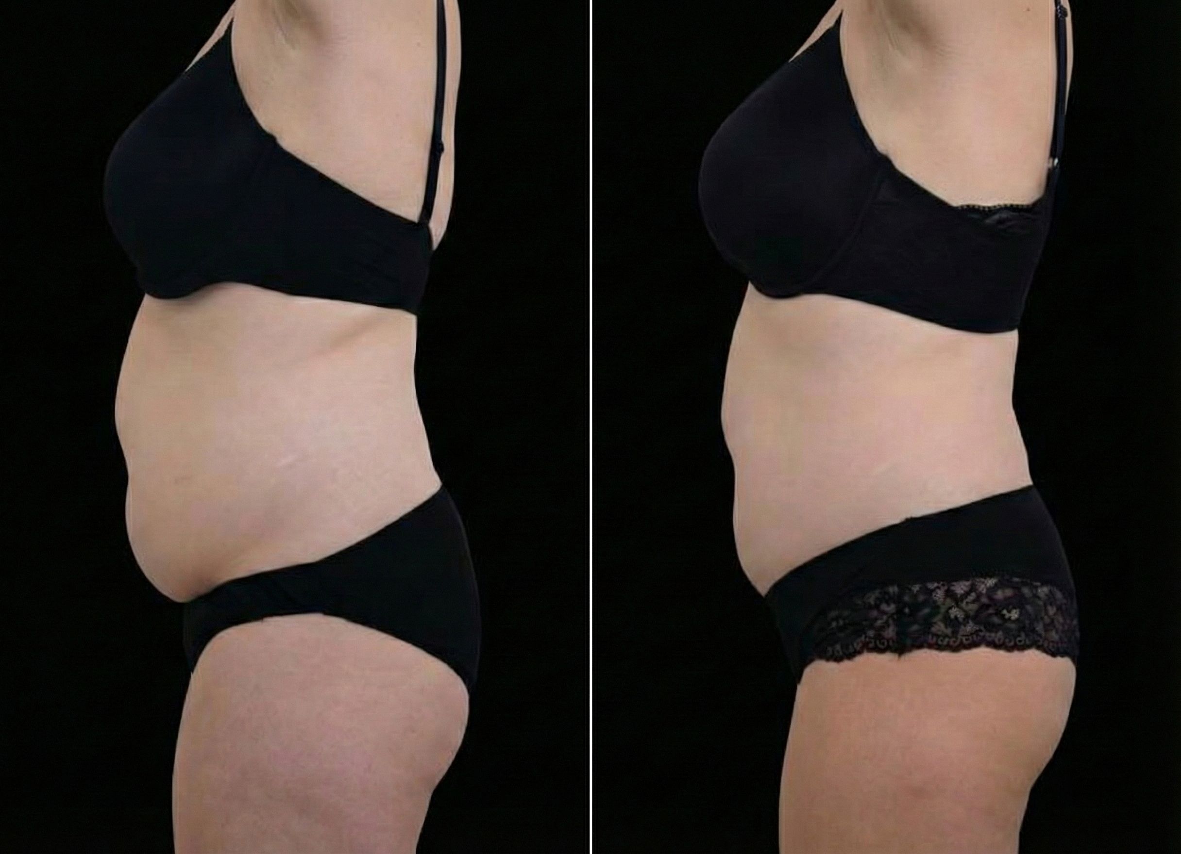 Emsculpt Neo effect on the stomach