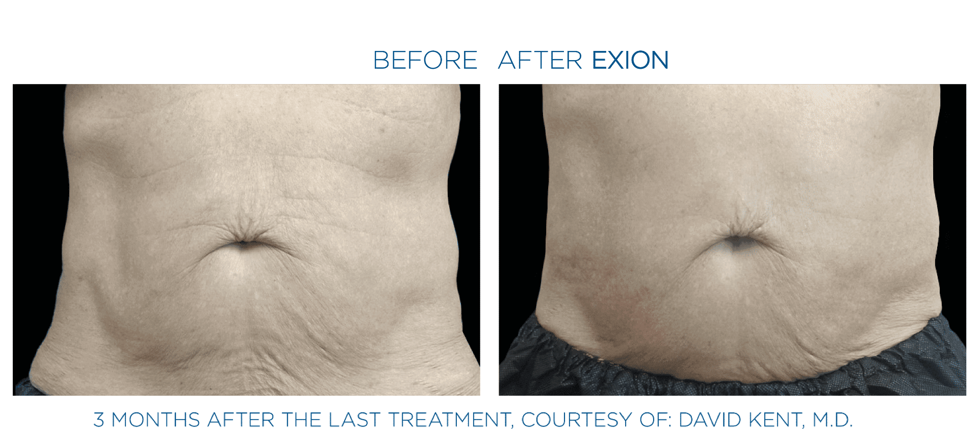 Before and after Exion Body skin tightening results.