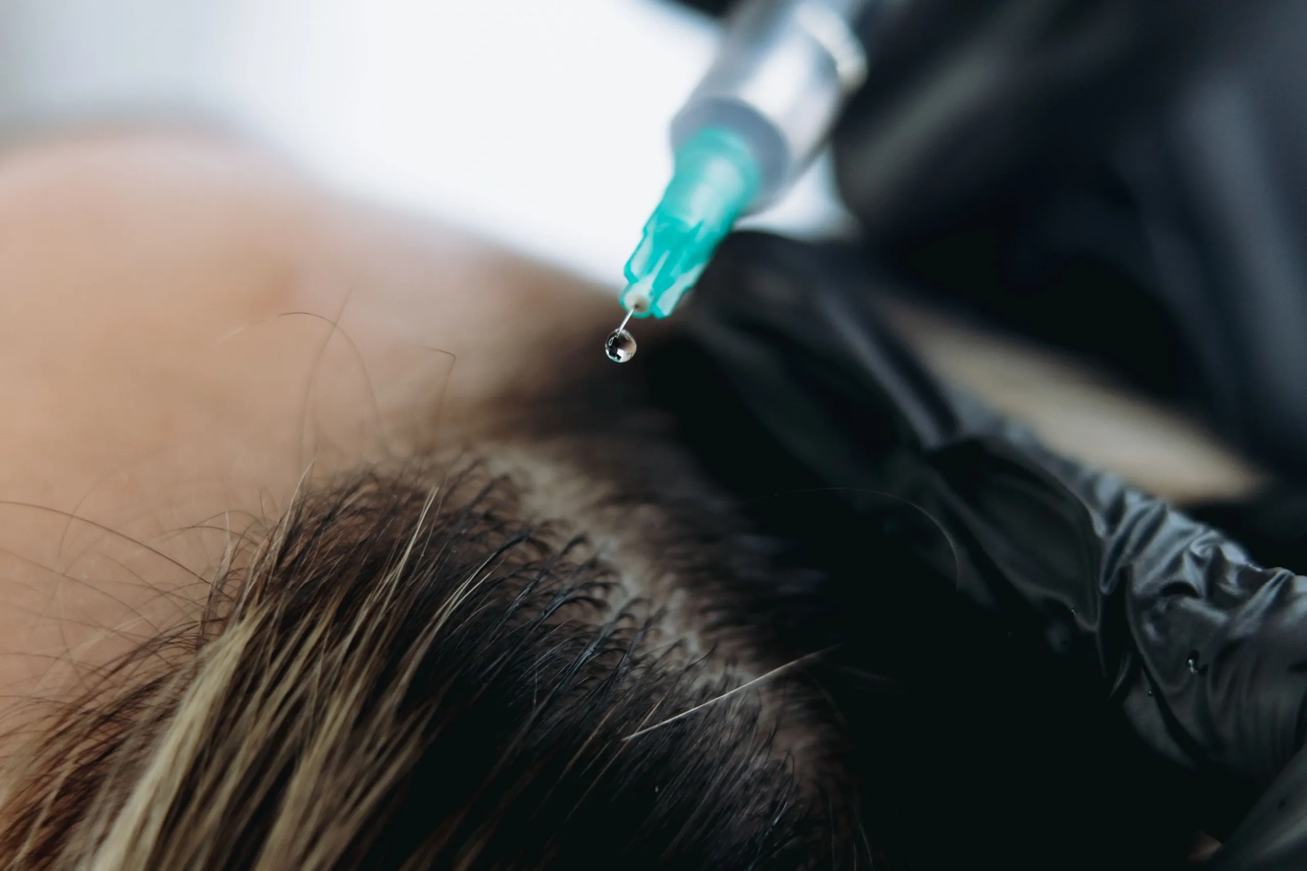 Patient receiving exosome hair therapy scalp treatment at Pura Vida Med Spa in Fulton, MD