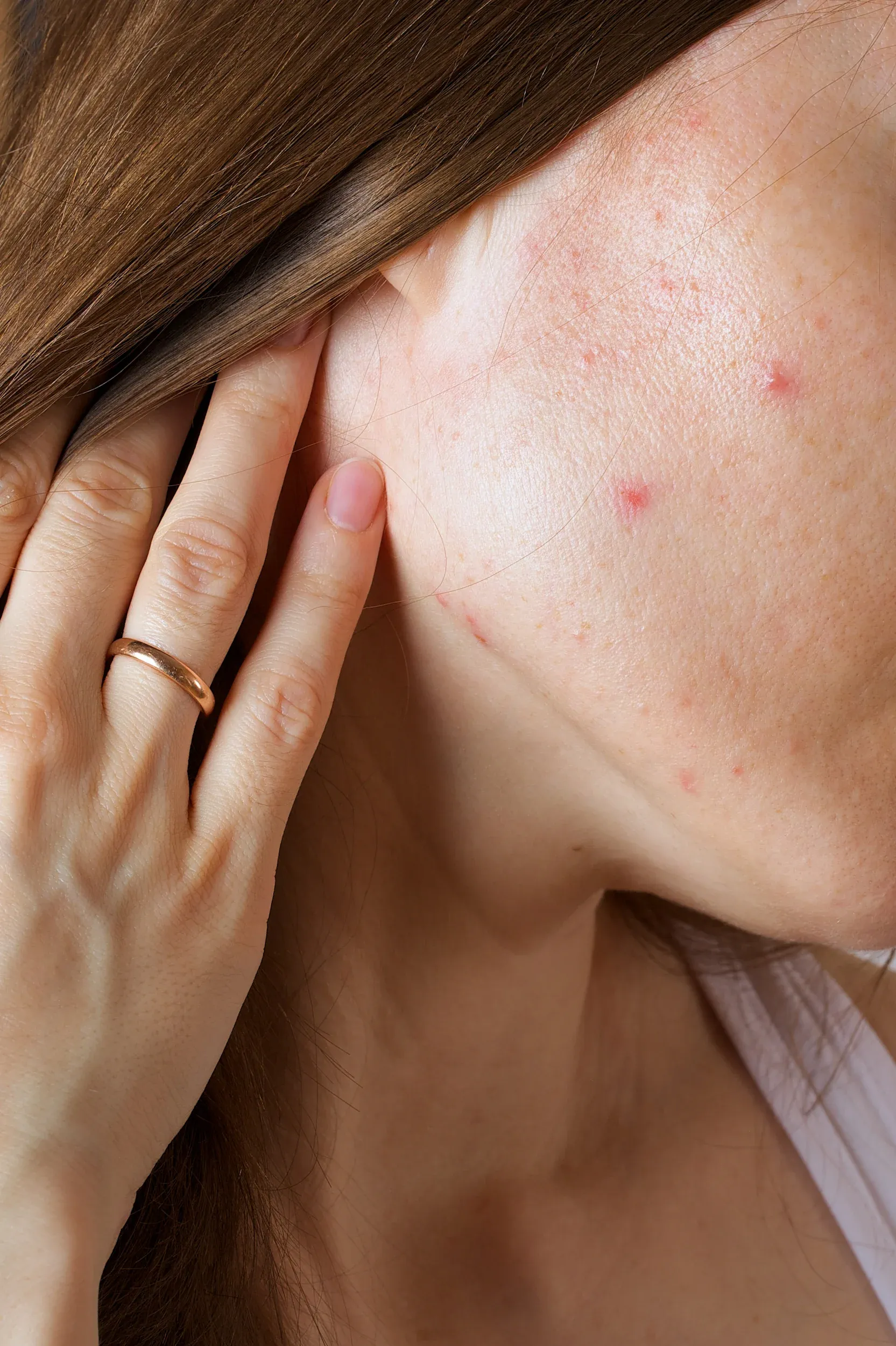 Before and after Face Reality acne treatment results at Mint Aesthetics & Skin Indianapolis