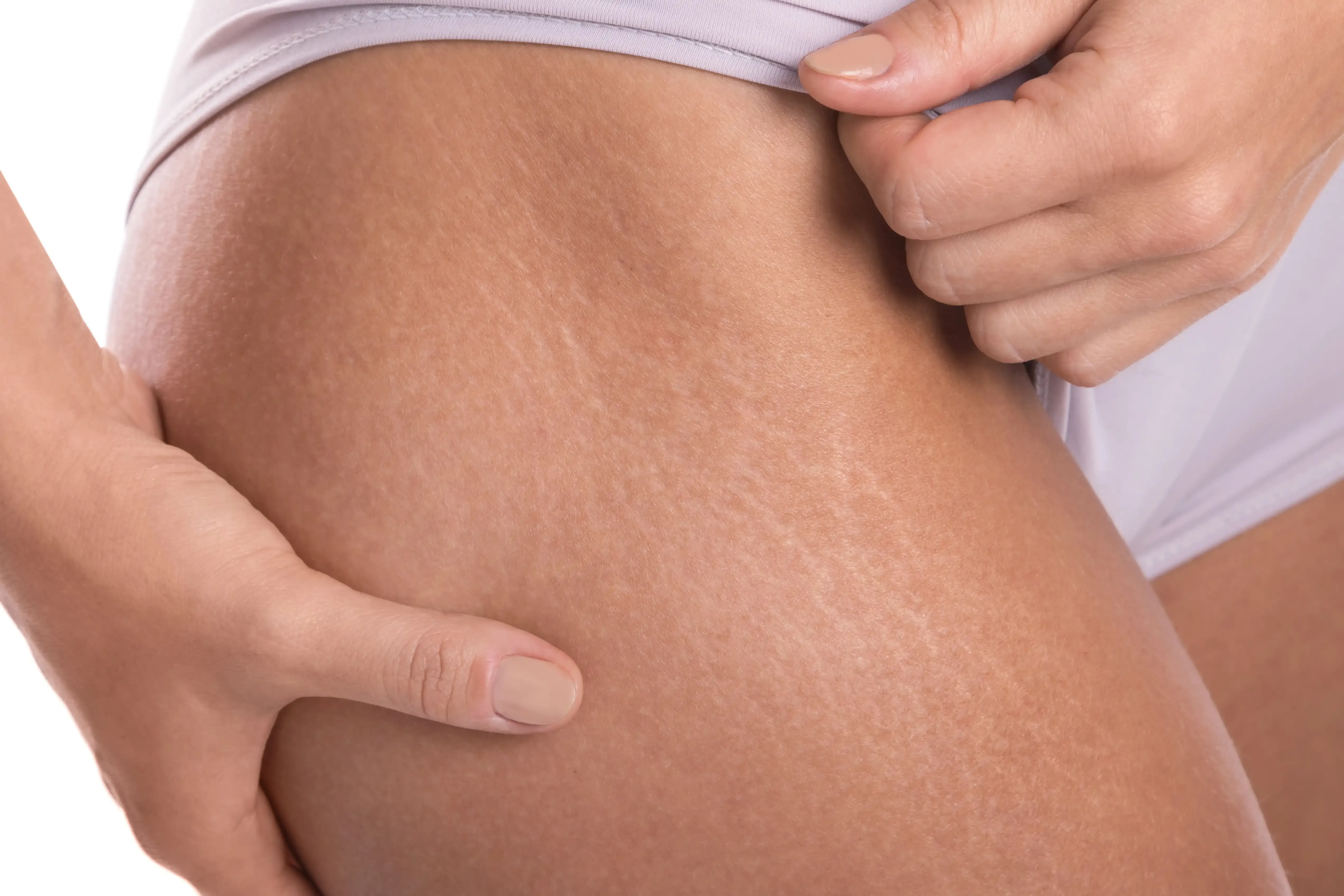Lifestyle and biological factors influencing stretch marks at Heritage Wellness & Med Spa Crescent Springs