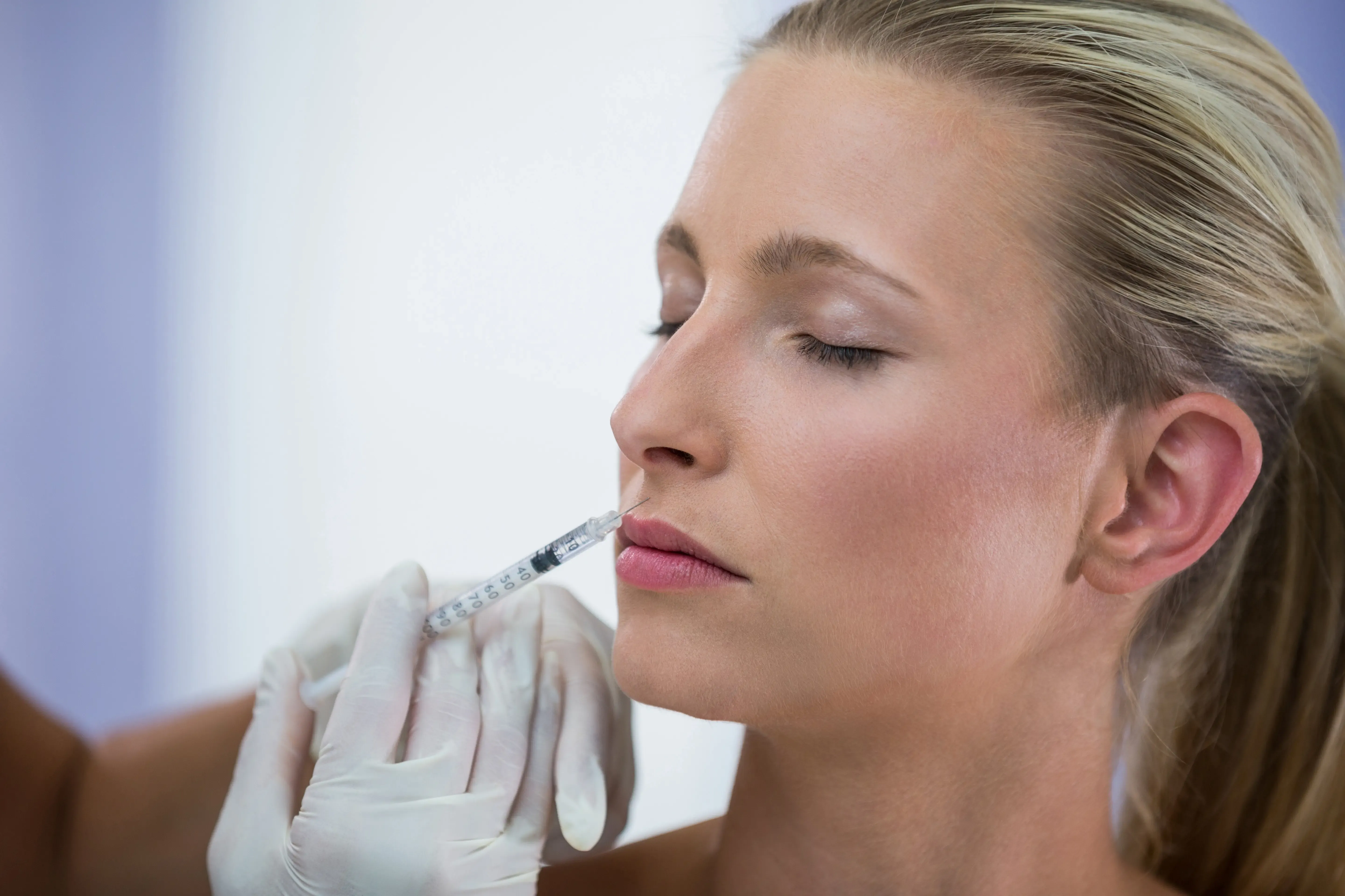 Before and after Juvederm and lip filler results at East Ellijay Dental in East Ellijay GA