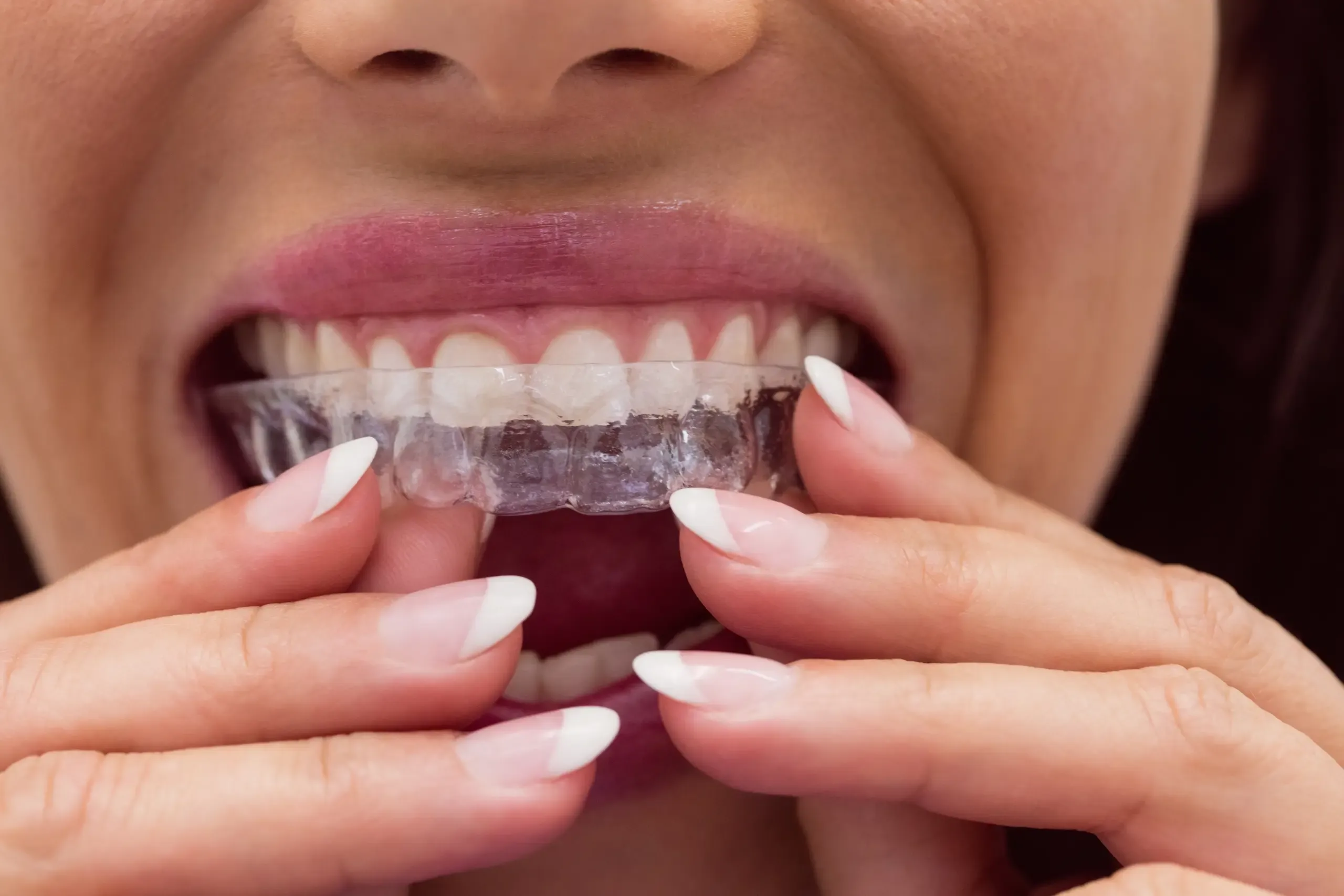 Invisalign clear aligners treatment at East Ellijay Family & Cosmetic Dentistry in East Ellijay GA