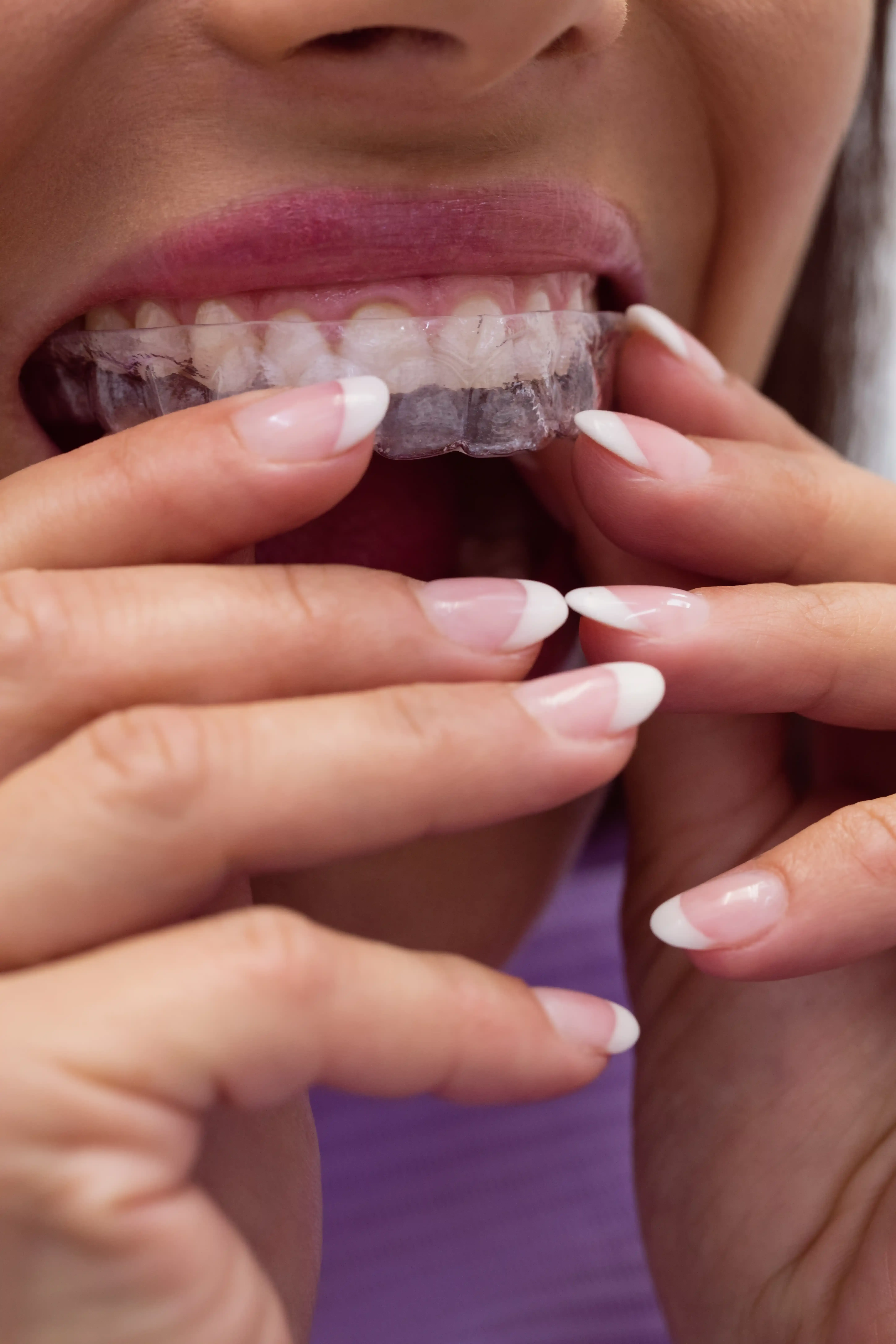 When Crooked Teeth Call for Invisalign Treatment