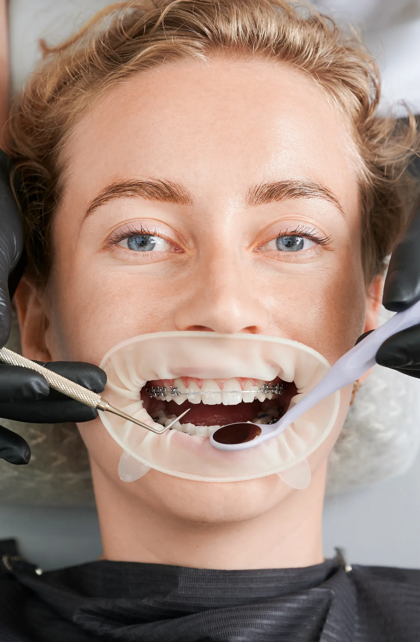 Composite resin filling materials used at Dental World Longwood