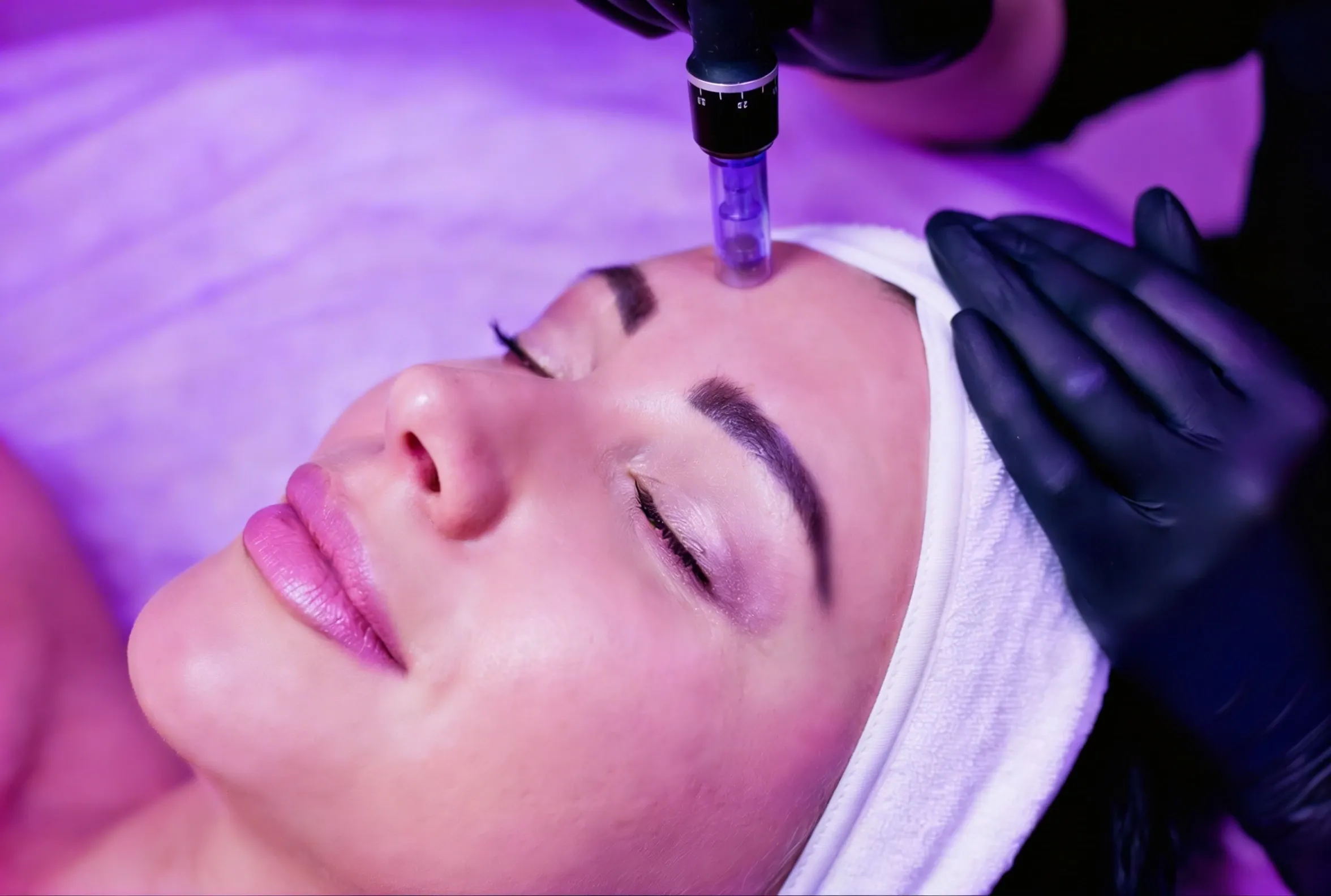 Microneedling treatment at RegalMed Clinic in Fort Myers, FL