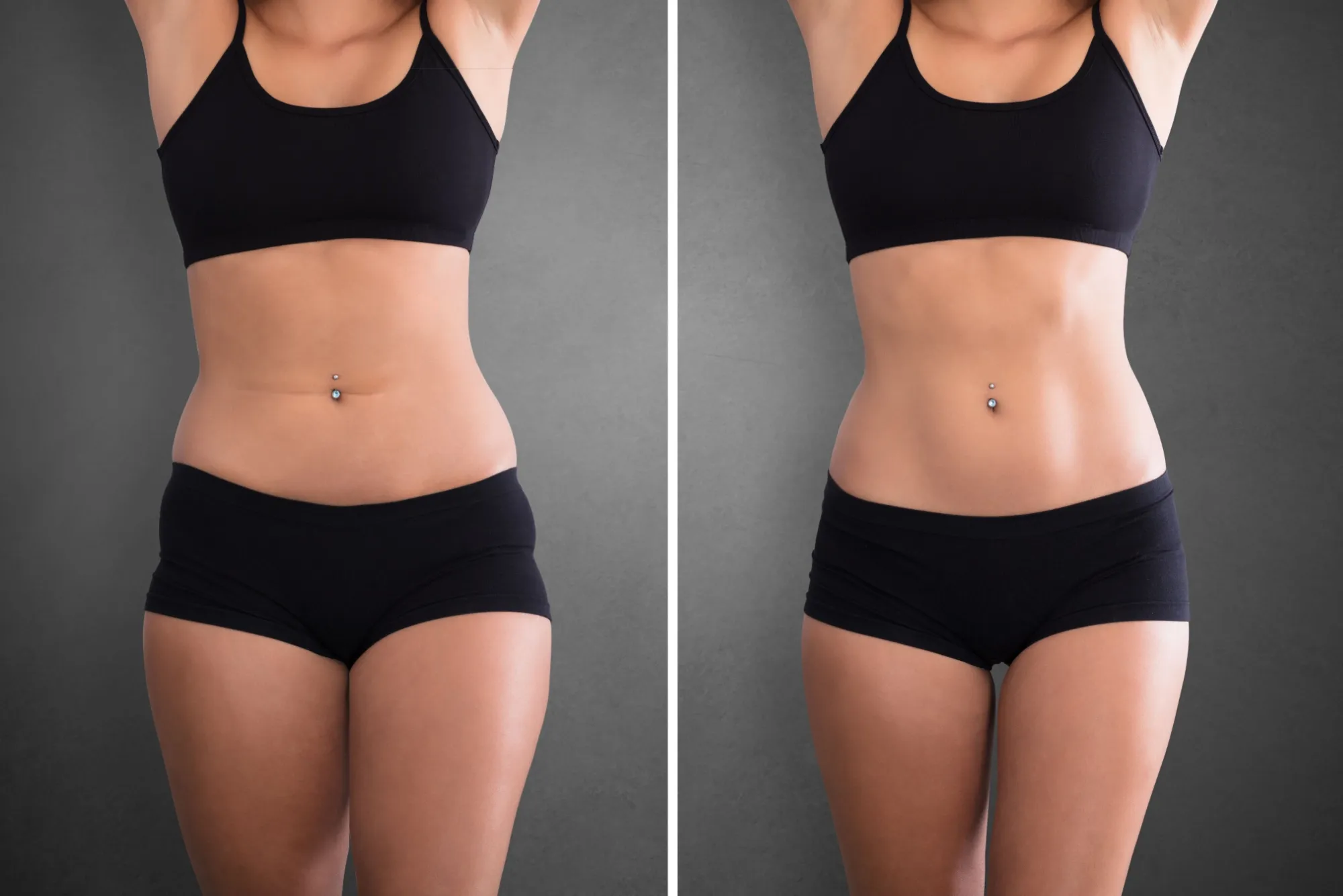 GLP-1 Weight Loss in Venice, FL - Before and After