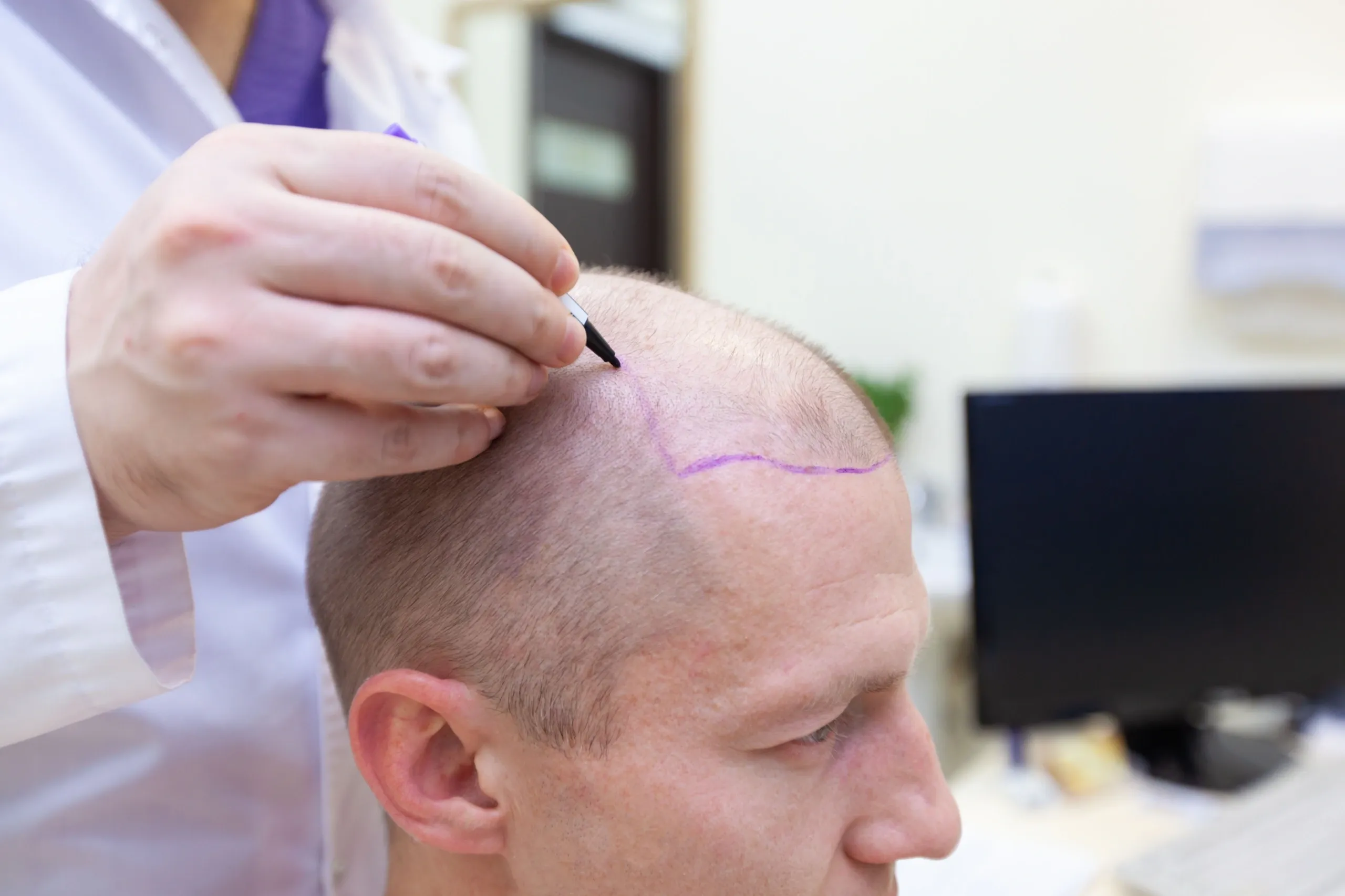Understanding Hair Transplant Costs: Insights from Dr. Vic Khanna