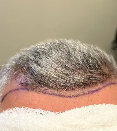 Hair transplant surgery at DSI Hair Illinois