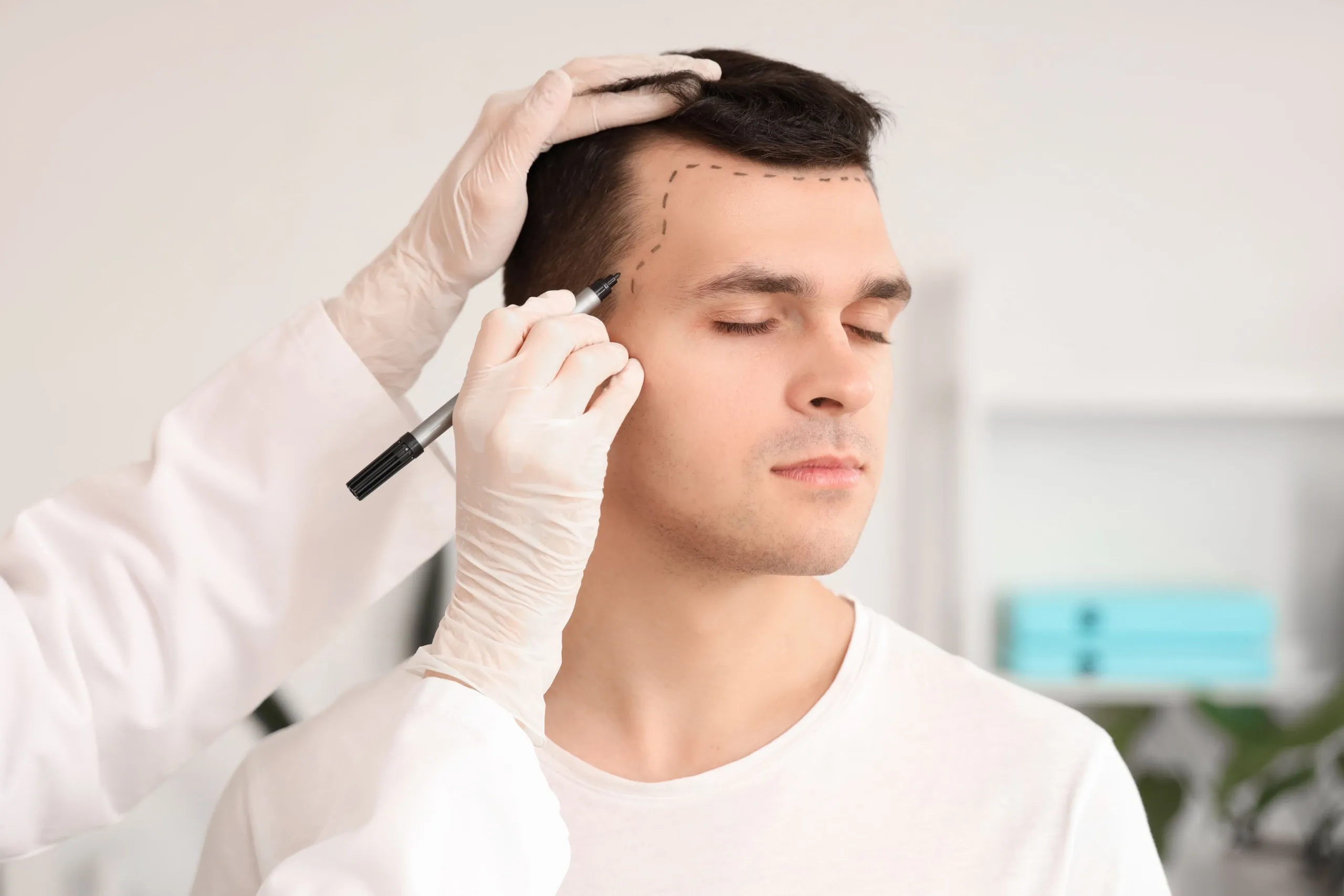 Hair Transplant Recovery Timeline