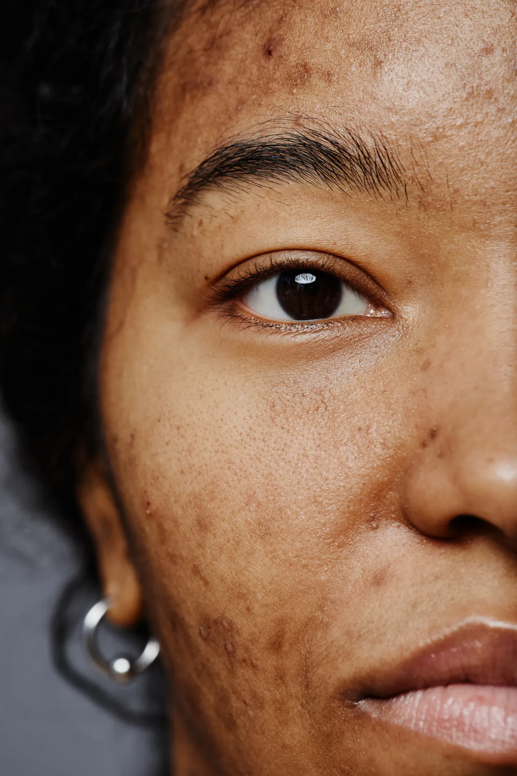 Close-up of uneven skin tone concerns at Mint Aesthetics & Skin Indianapolis