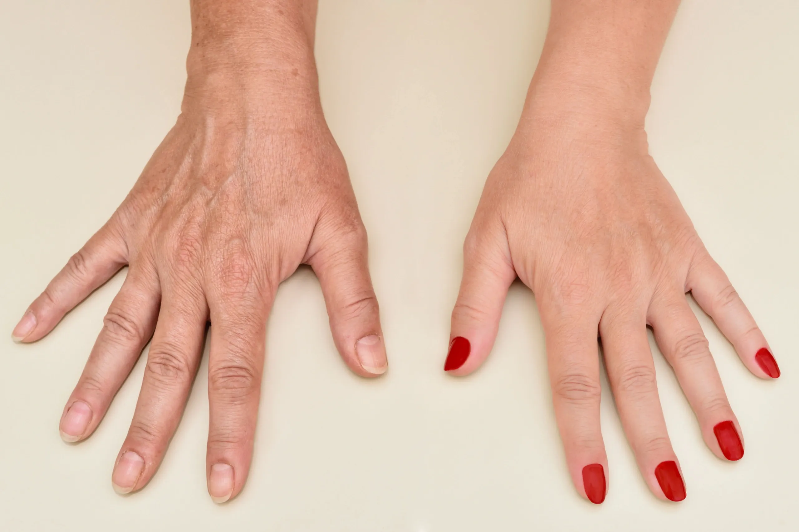 Hand rejuvenation treatment to restore youthful appearance