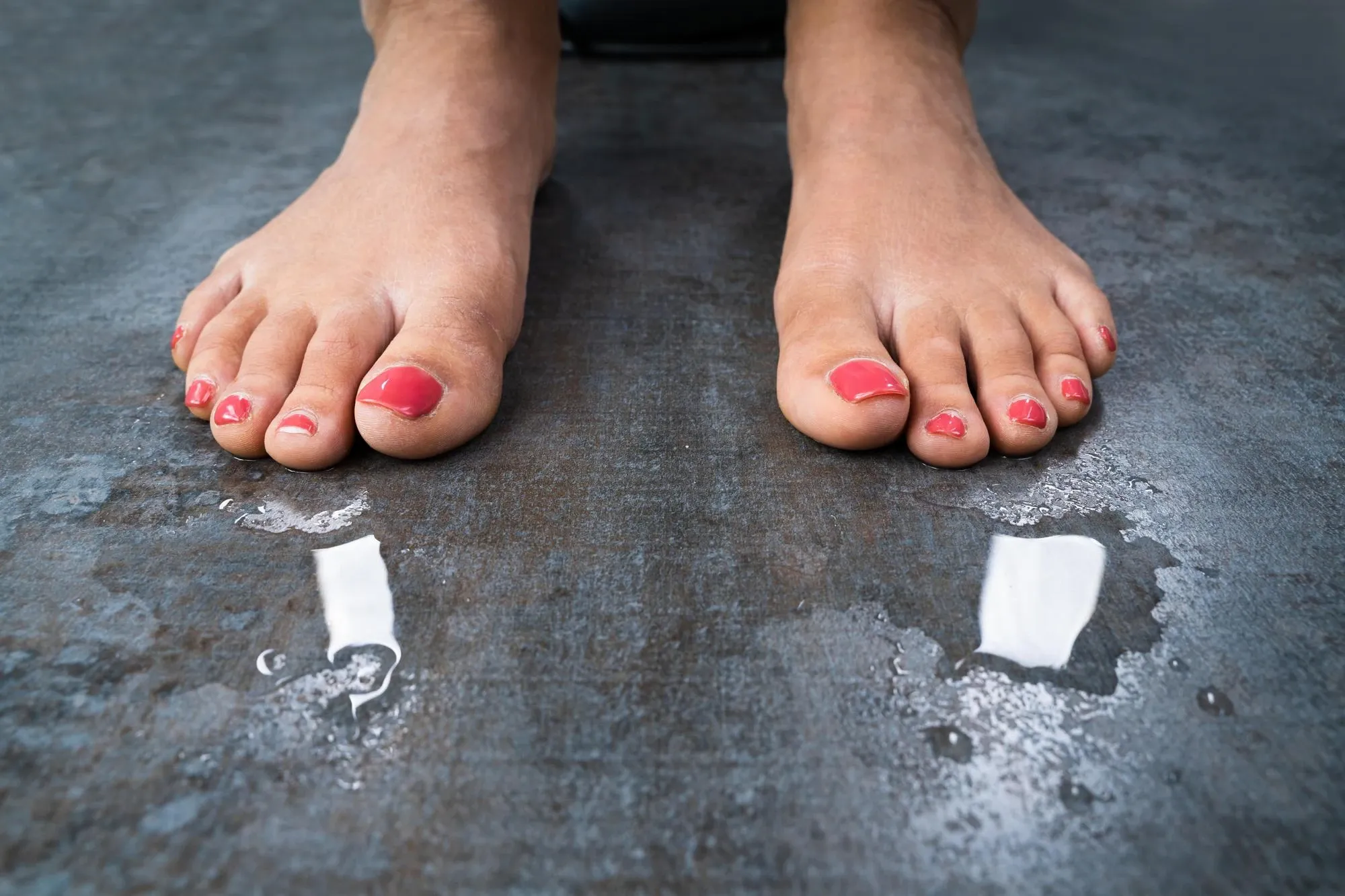 Lifestyle factors contributing to hyperhidrosis at Mint Aesthetics & Skin Indianapolis