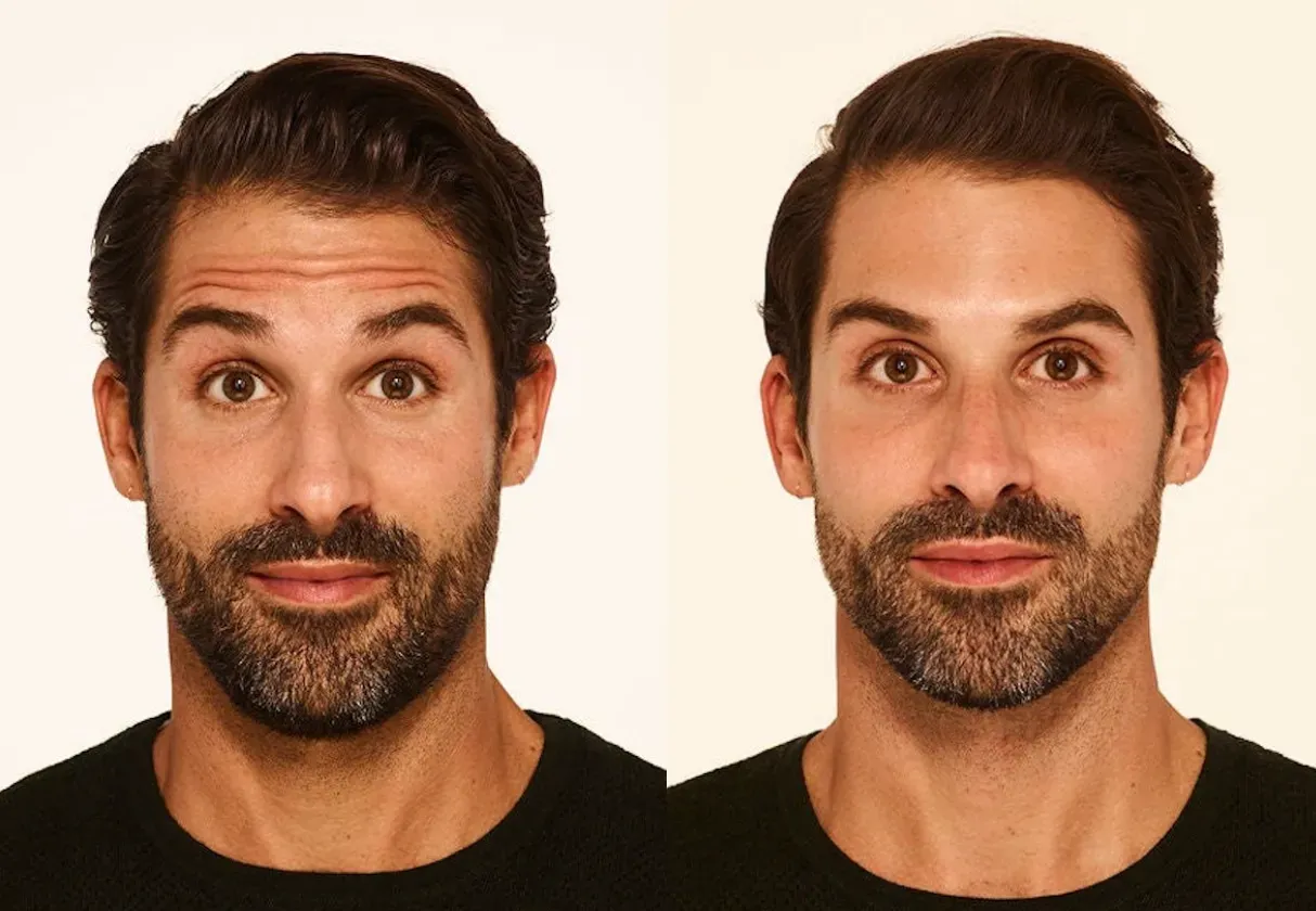 Botox  - Before and After