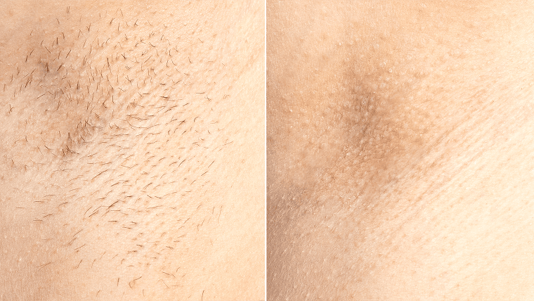 Laser Hair Removal Elite iQ | Cambridge, MA before and after