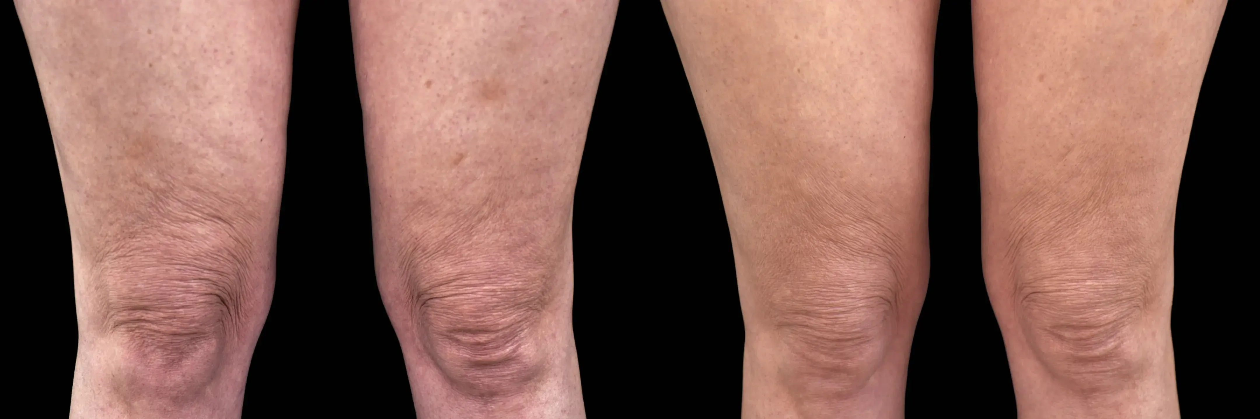 Emtone in Tampa, FL - Before and After