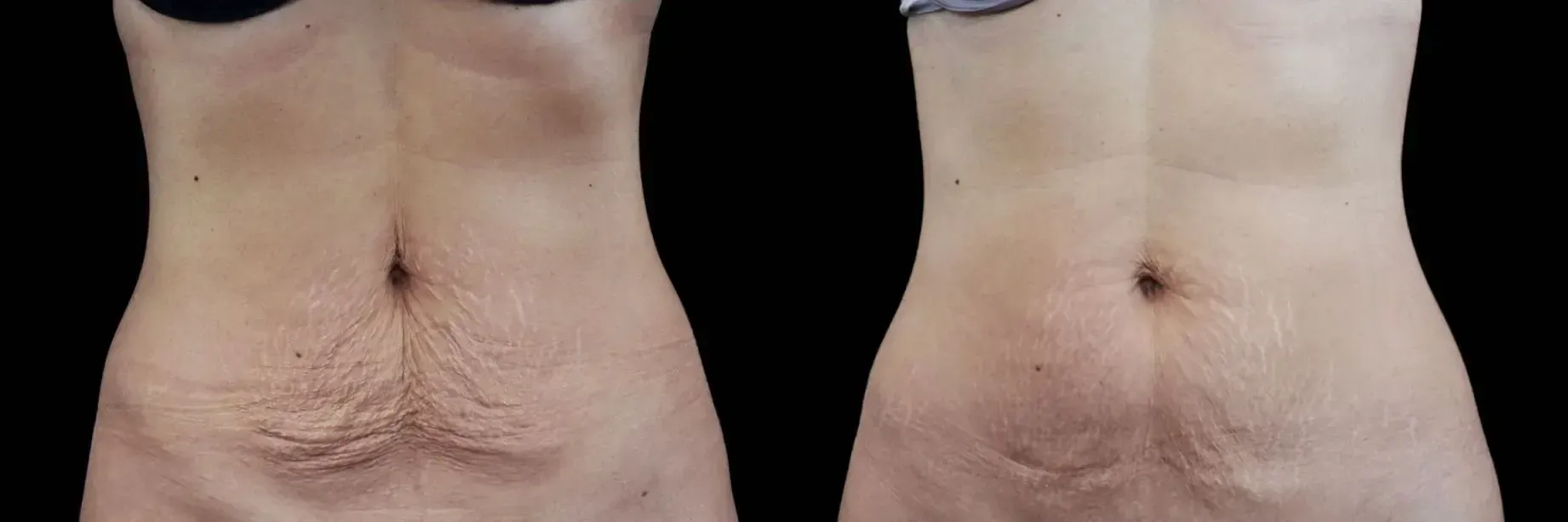Emtone in Tampa, FL before and after