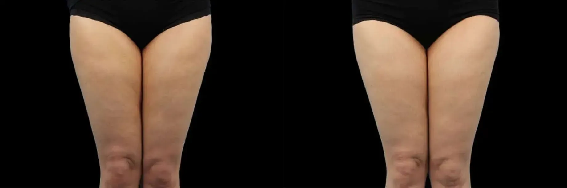 Emtone in Tampa, FL - Before and After