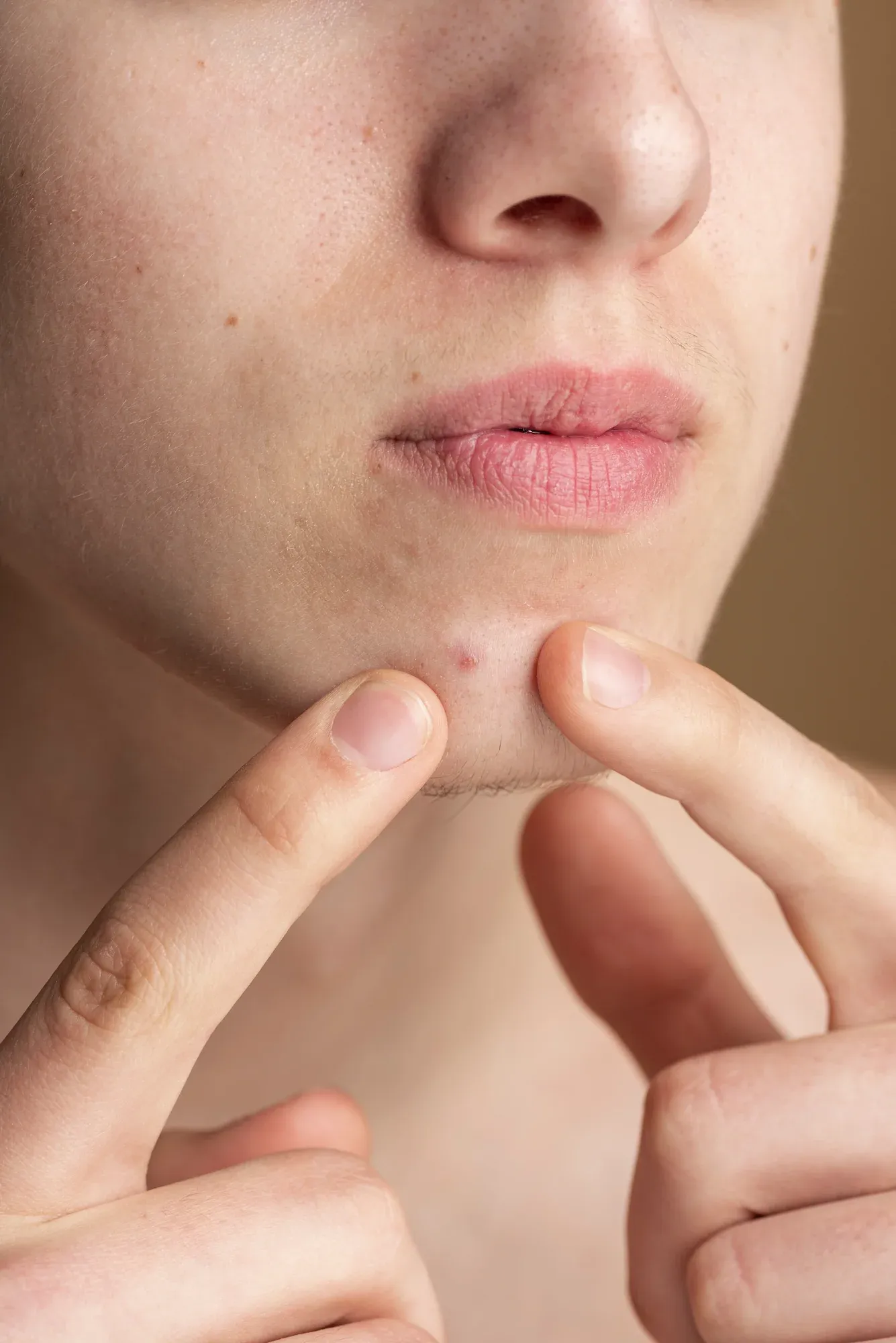 Diagram of facial pore anatomy showing sebum, dead skin, and follicle structure at Radiant Laser MD Cambridge