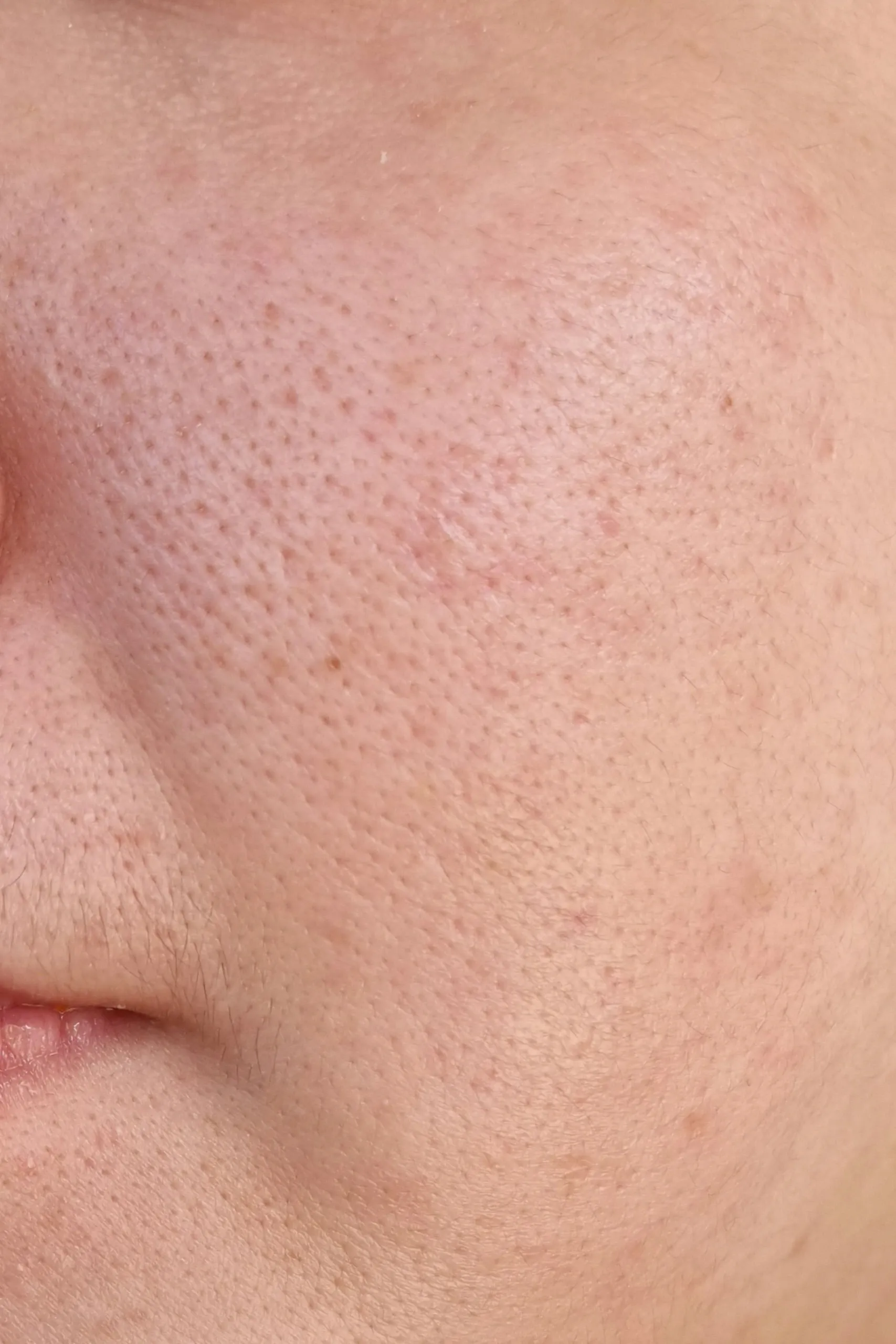 Person concerned about large pores consulting a provider at Resurgent Health Fargo