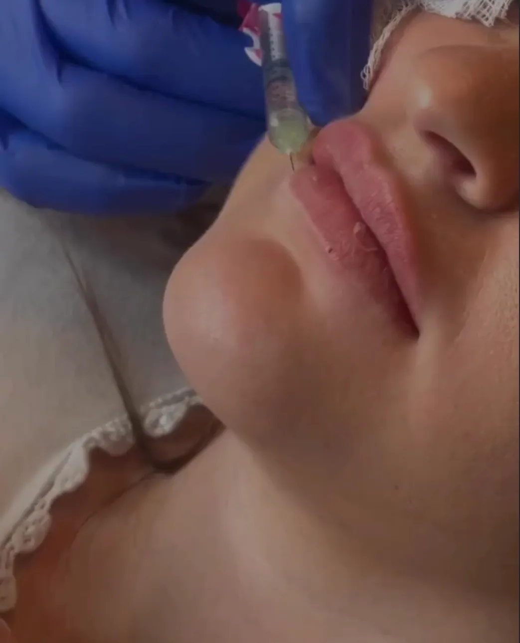 Before and after lip injection results showing natural volume enhancement at Eternal Wellness Traverse City