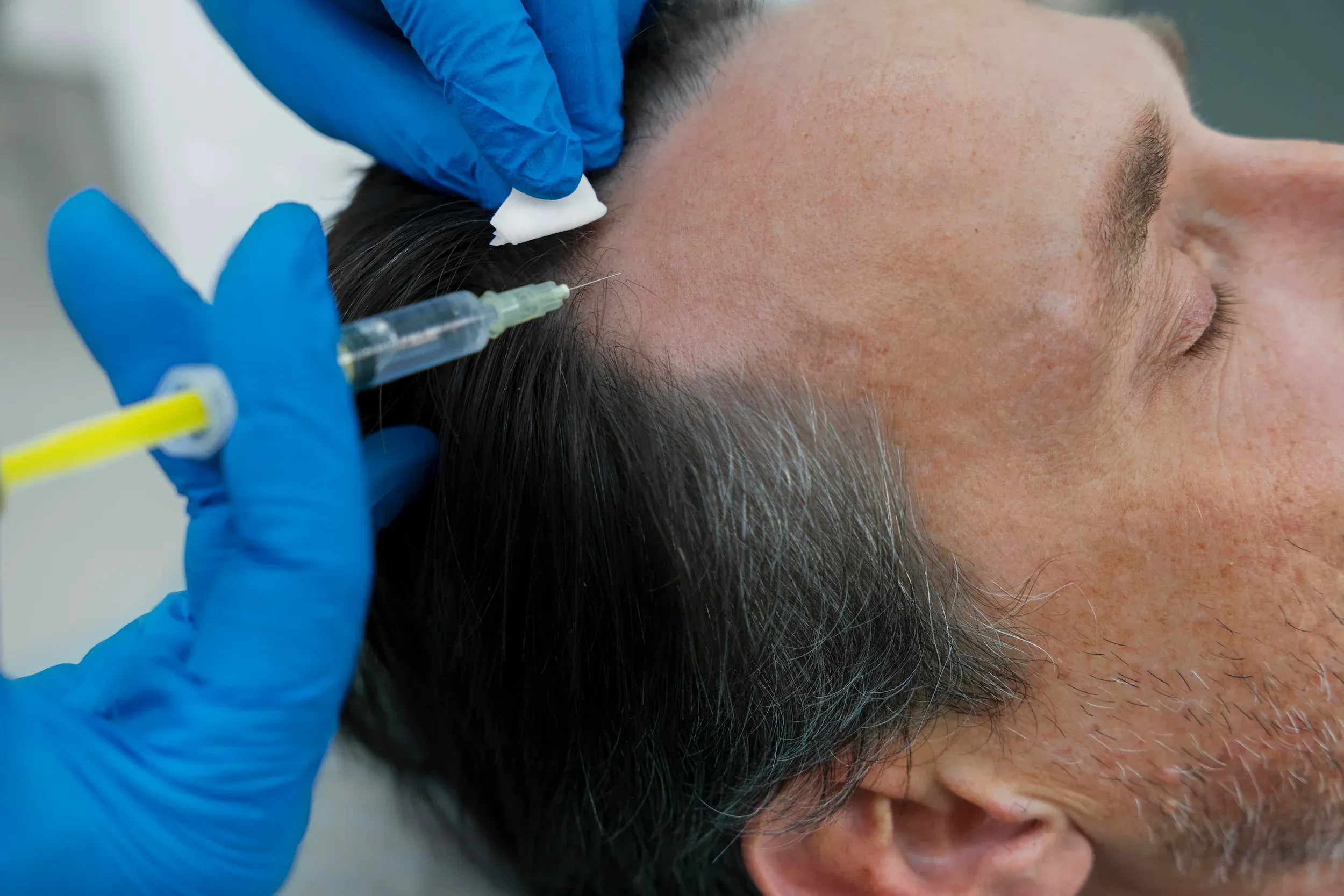 Patient receiving PRP hair restoration treatment at DSI Hair in Algonquin, IL