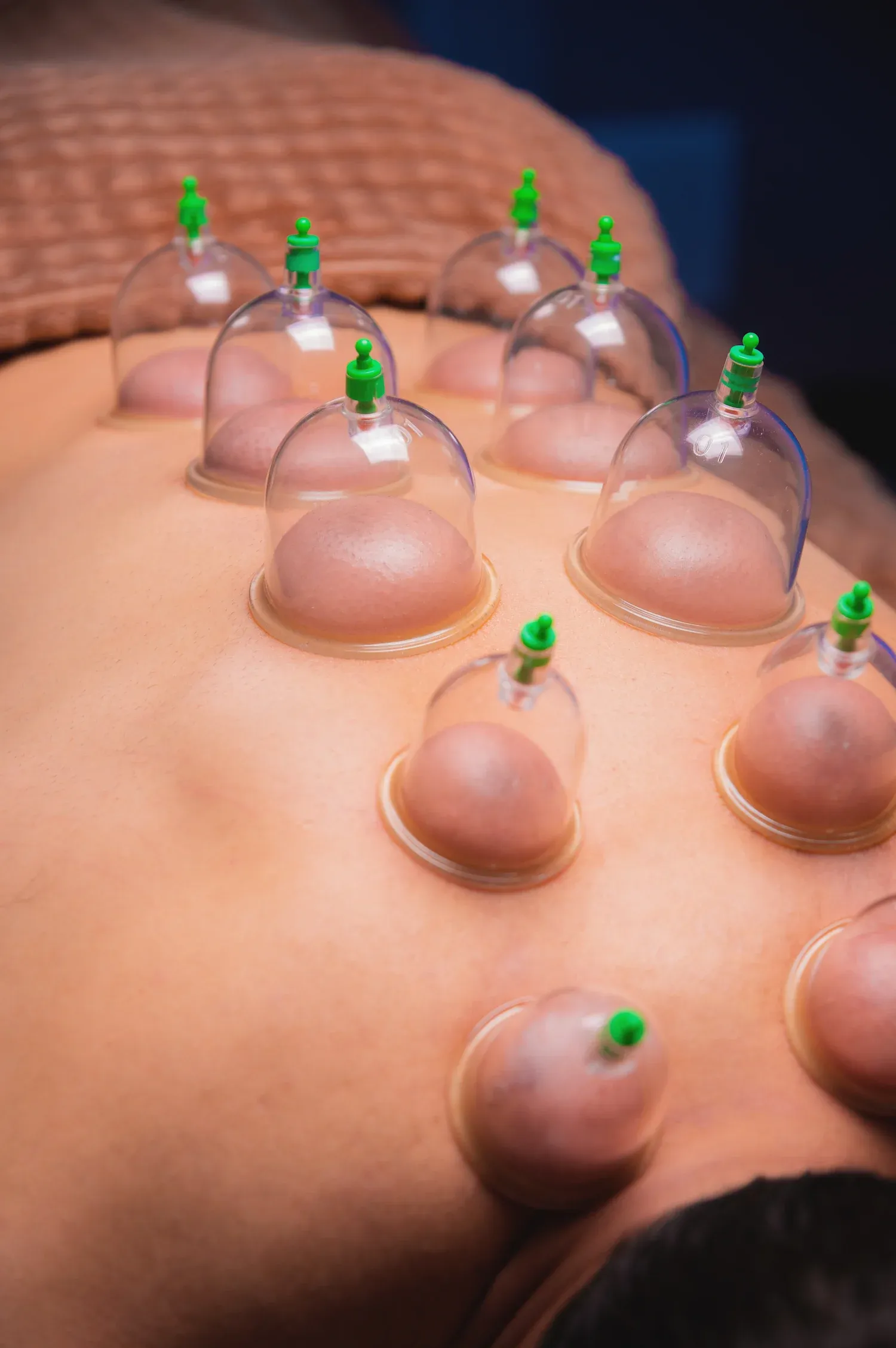 Cupping therapy cups used for soft tissue treatment at Bensa Chiropractic and Wellness Bradenton
