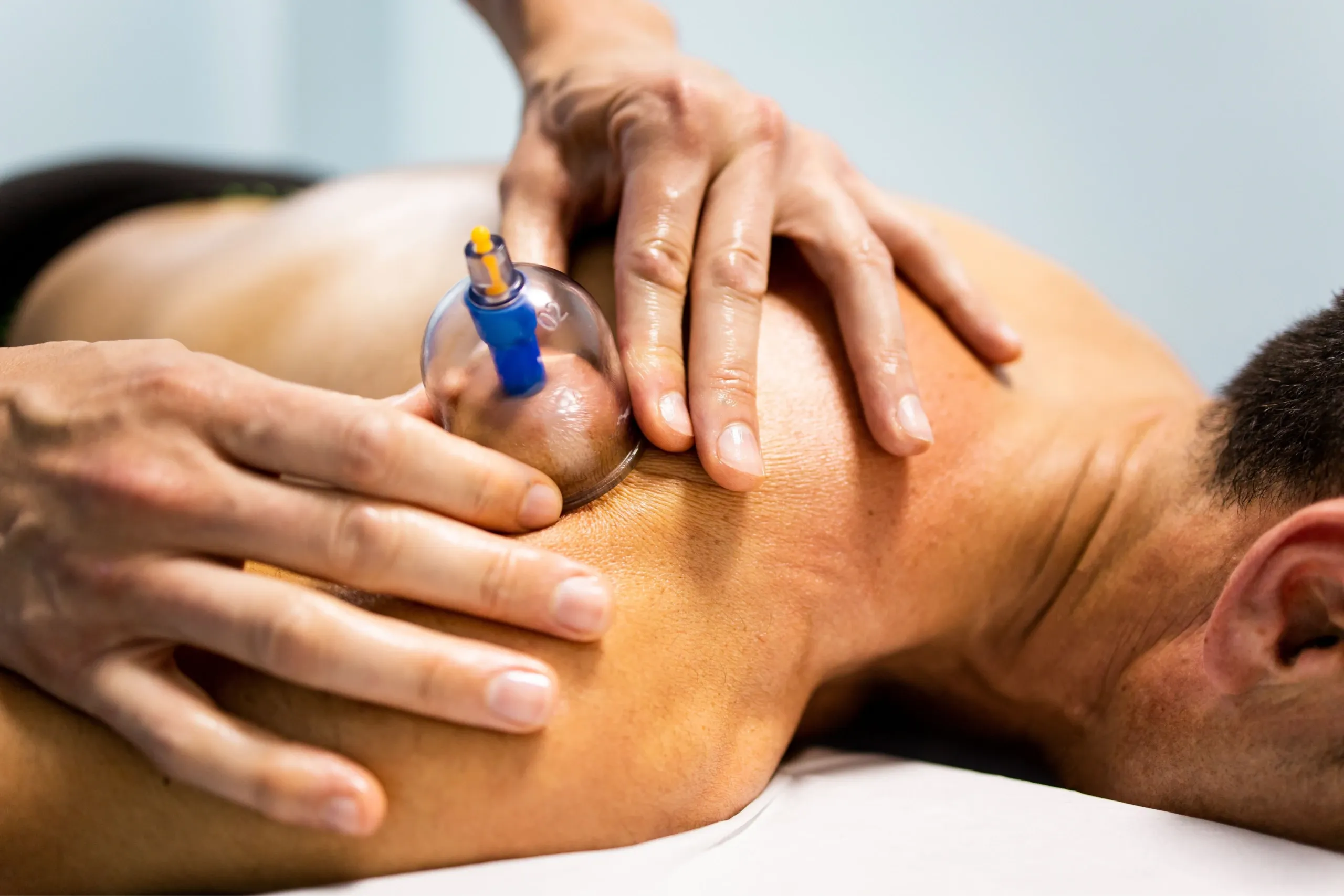 MediCupping therapy session for myofascial decompression in Alma, GA