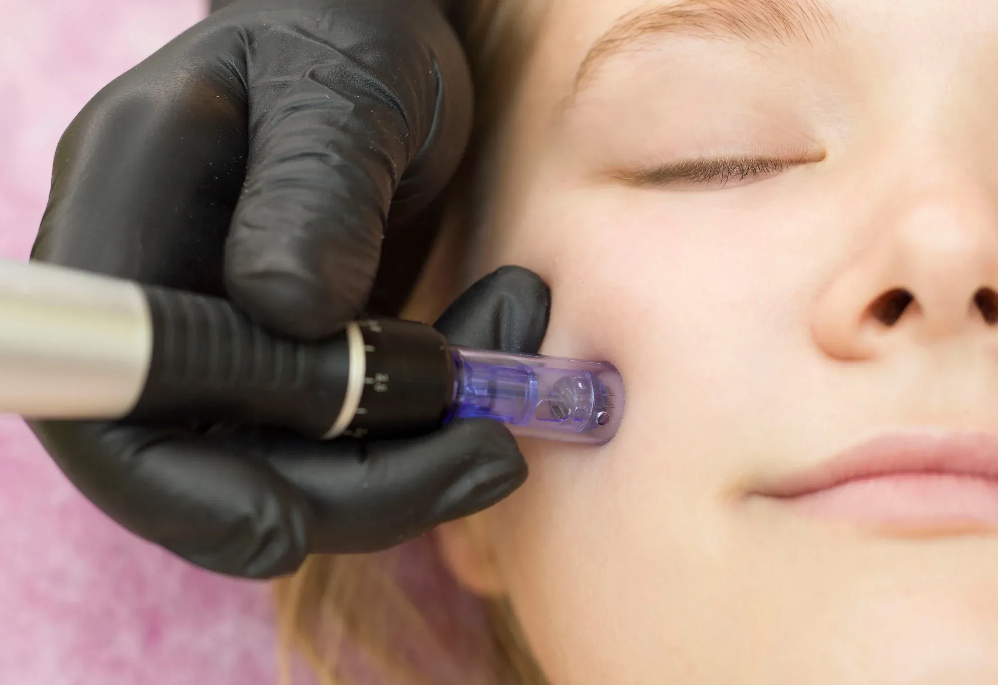Microneedling at Resurgent Health in Fargo North Dakota