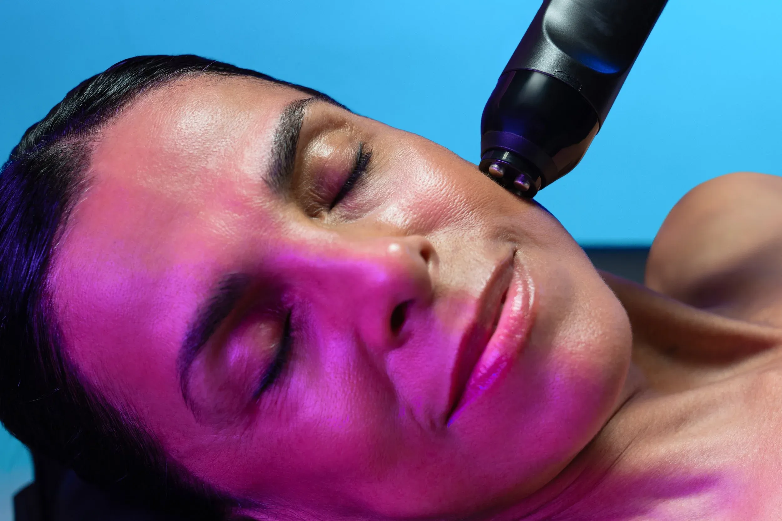 RF microneedling treatment at RegalMed Clinic in Fort Myers, FL