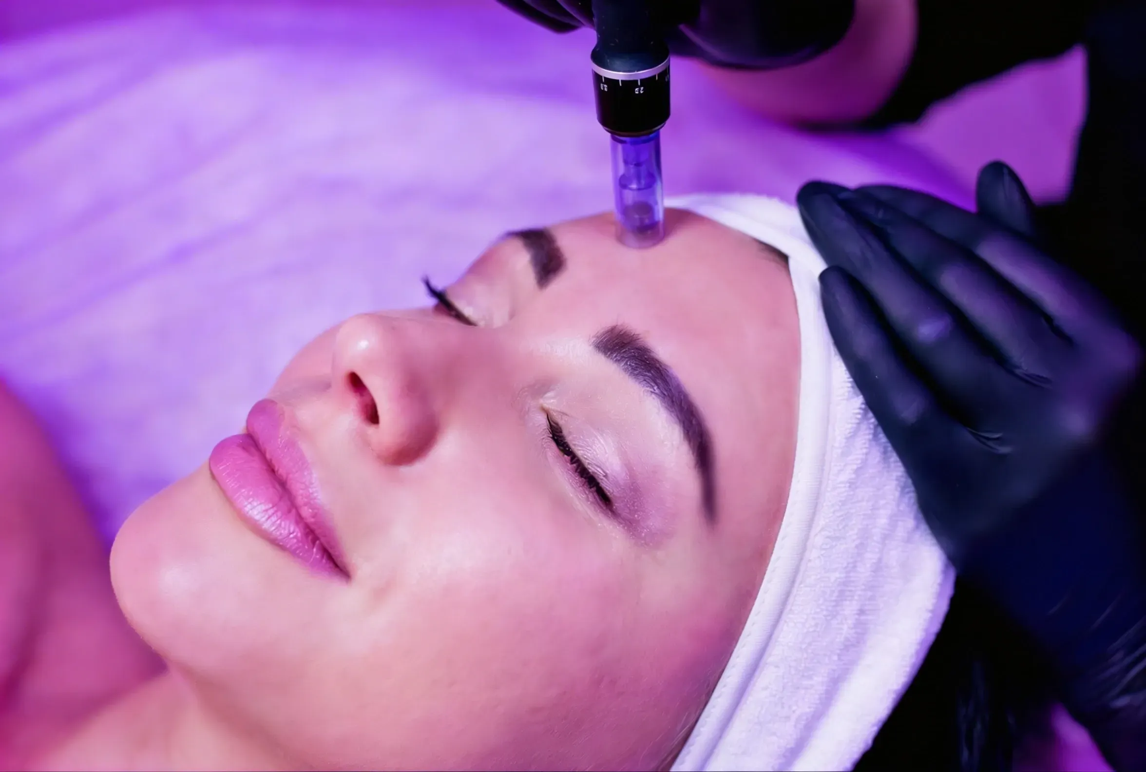 Patient consultation for microneedling at Mint Aesthetics & Skin Indianapolis