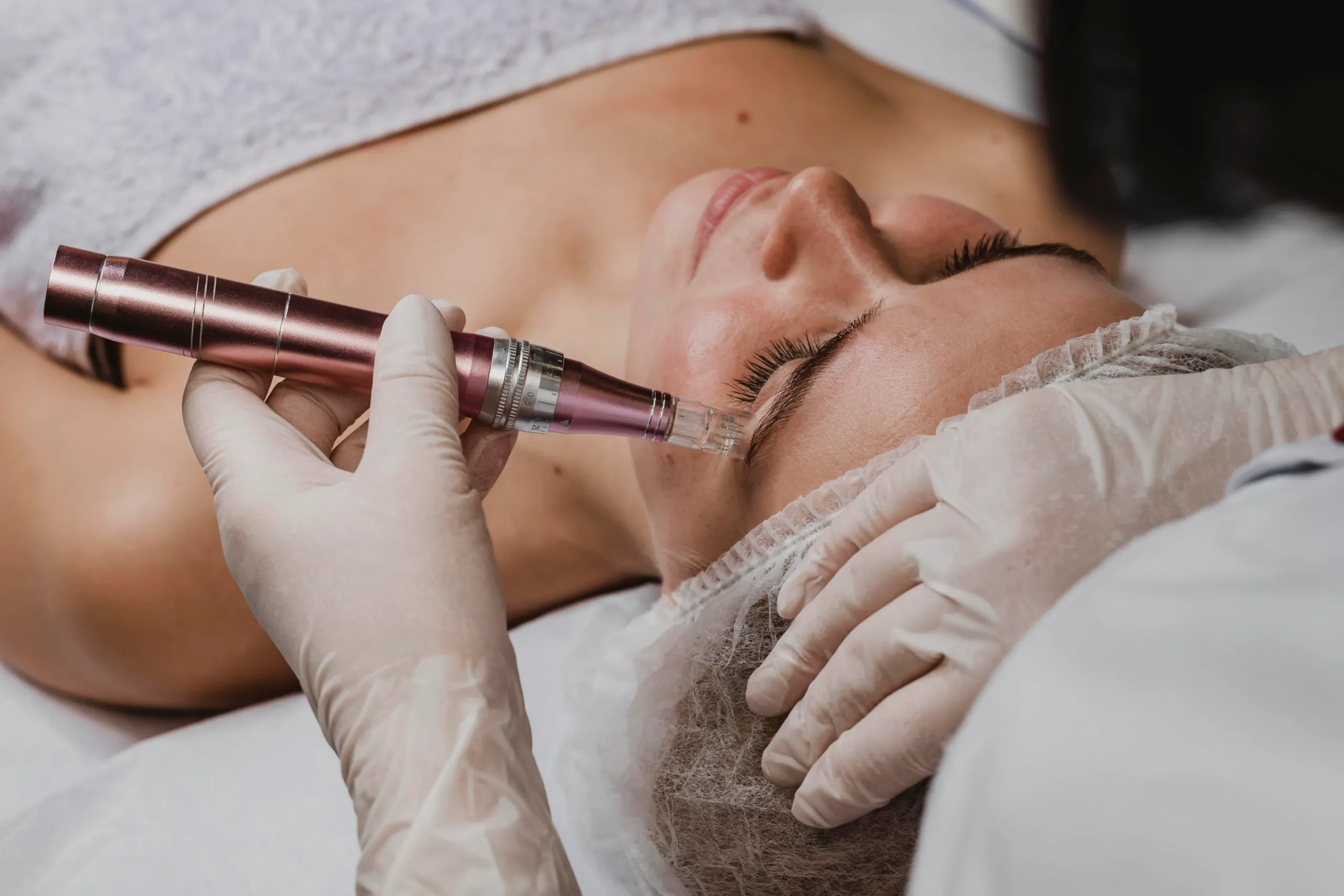 Microneedling treatment at Mint Aesthetics & Skin in Indianapolis IN